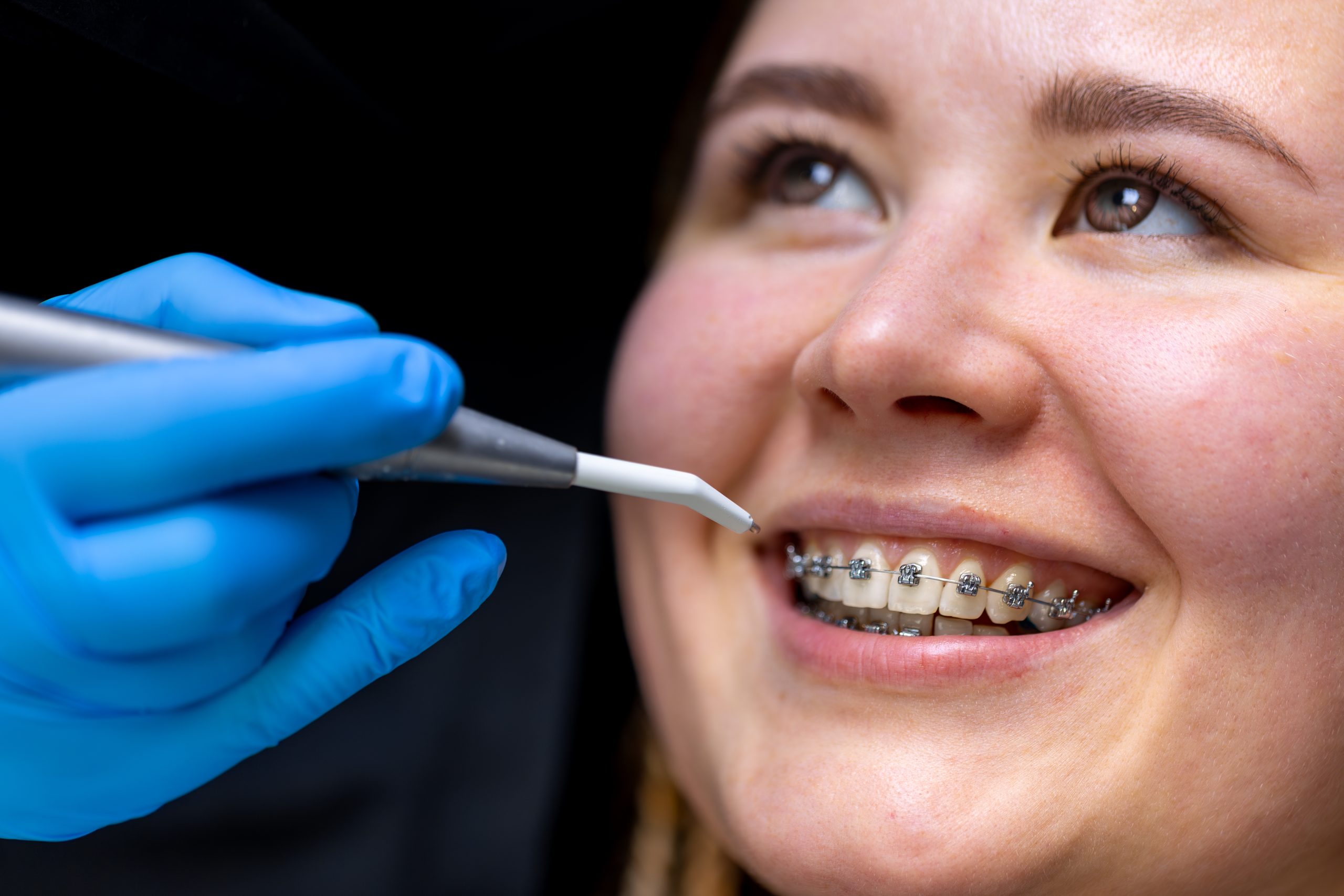 dental braces in Abu Dhabi — before & after