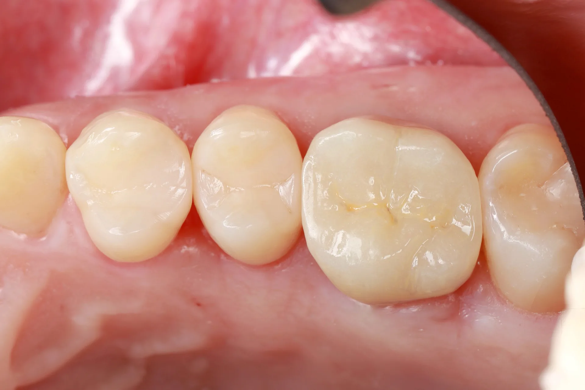 Ceramic Overlay — Tooth 3 after