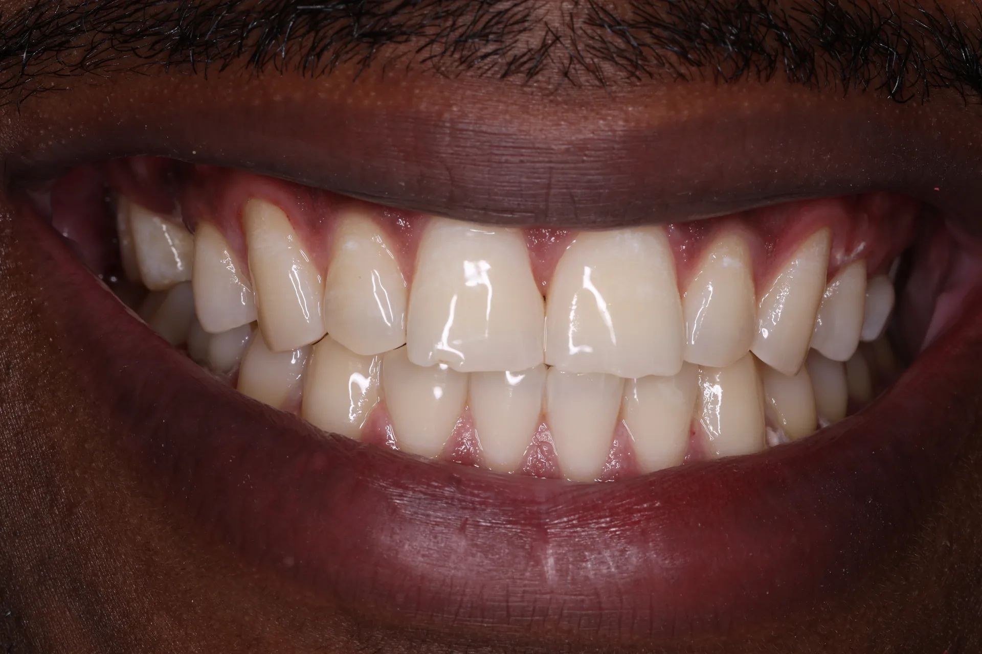 Zoom Whitening after