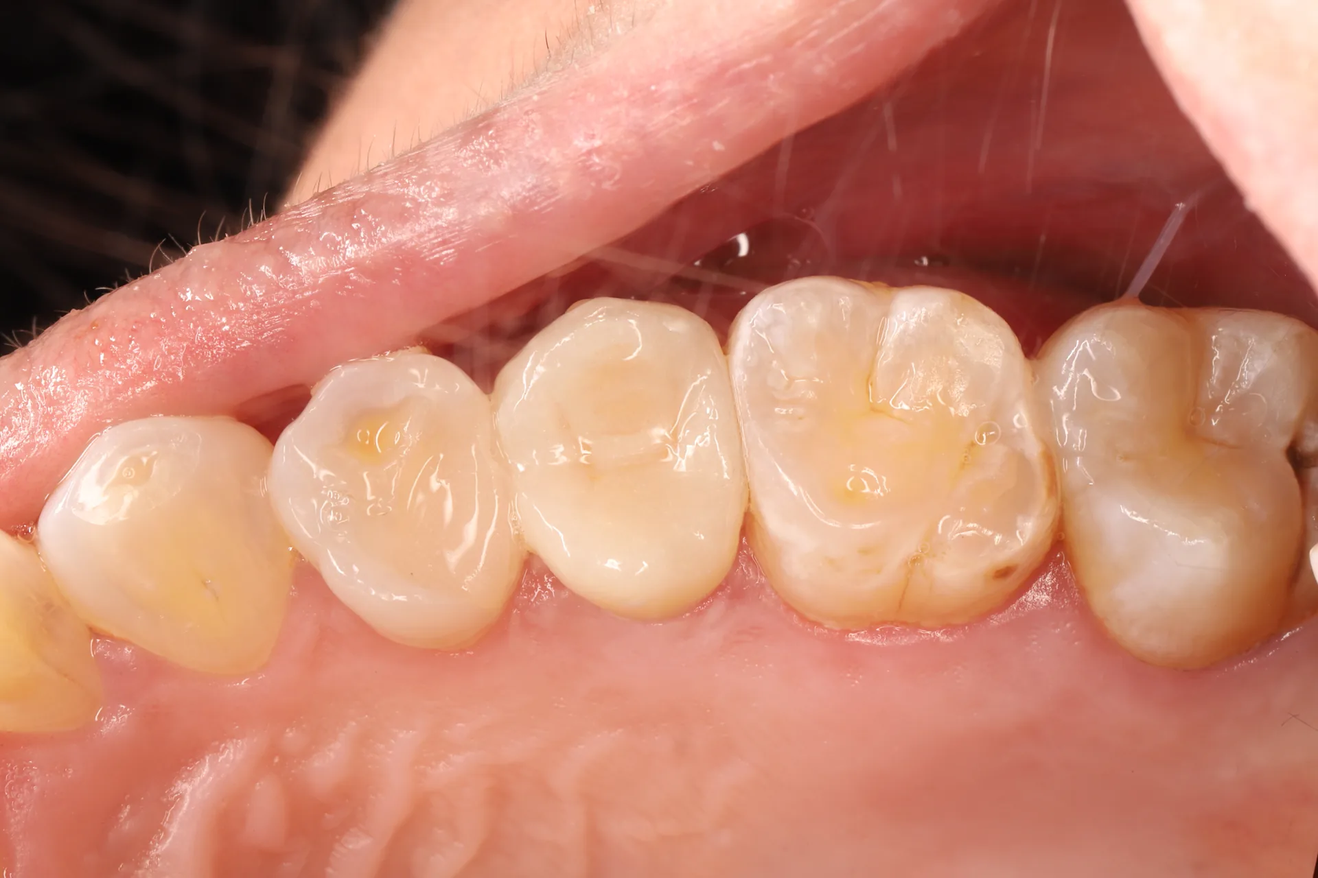 Ceramic Crown — Tooth 25 after