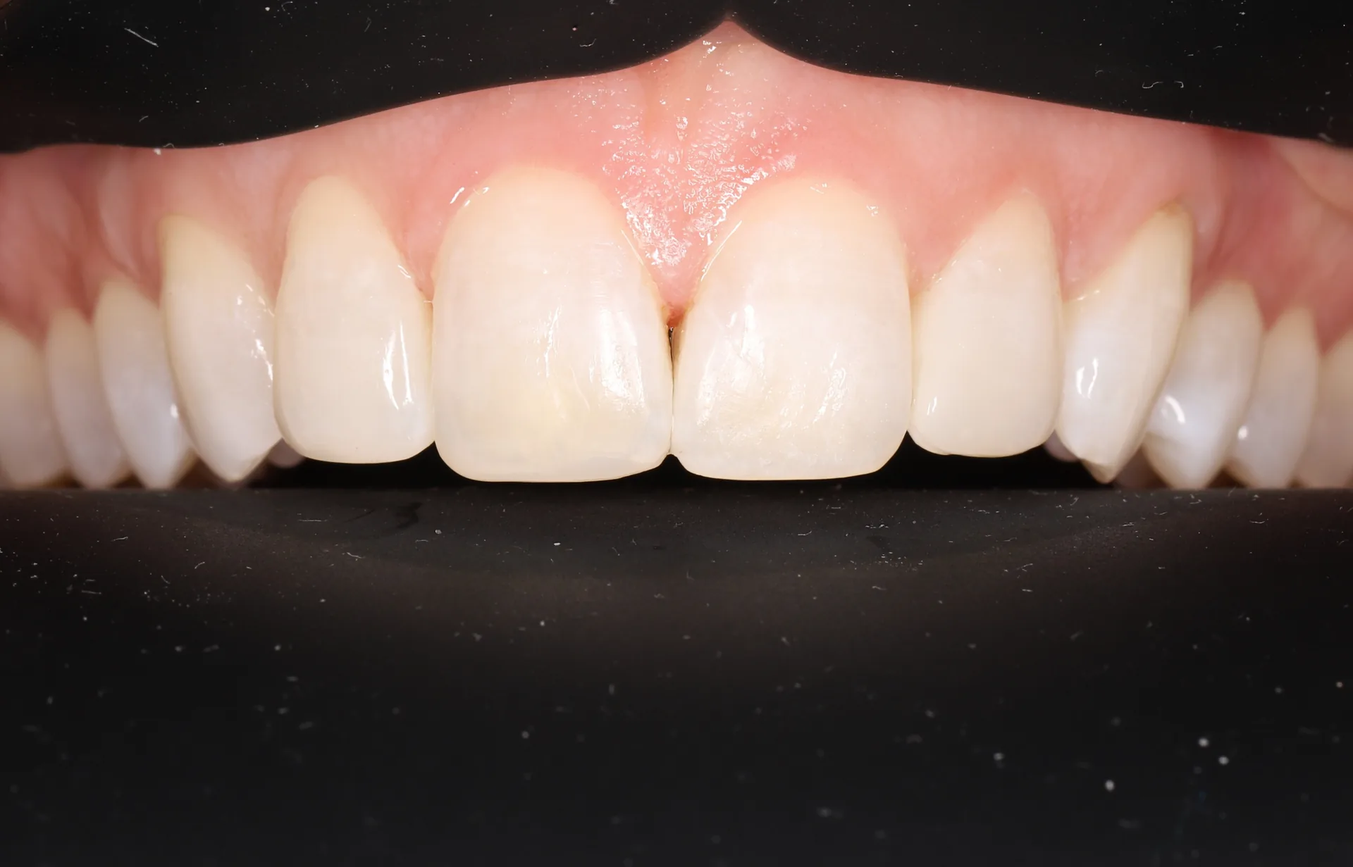 Chipped Teeth Restoration after
