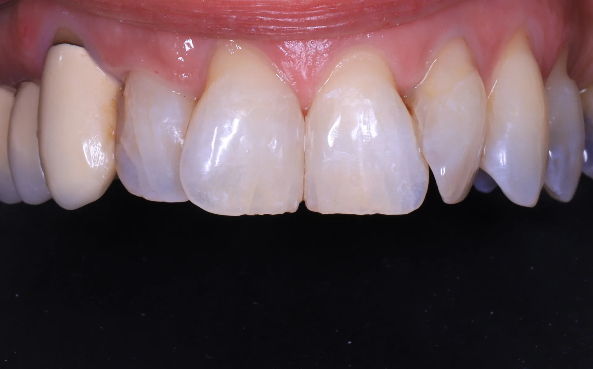 Seamless Caries Restoration — Front Teeth after