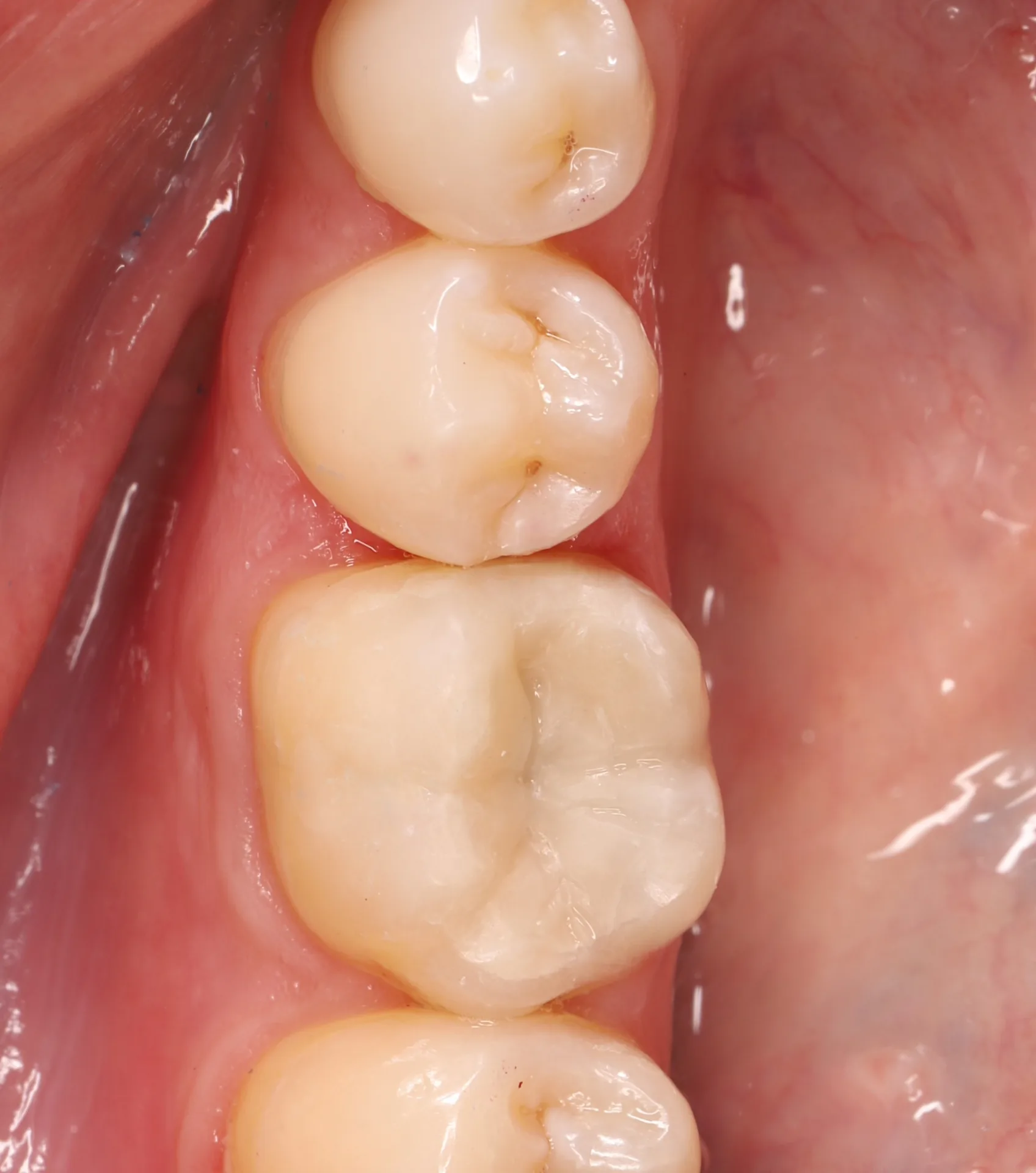 Amalgam Replacement — Tooth 36 after