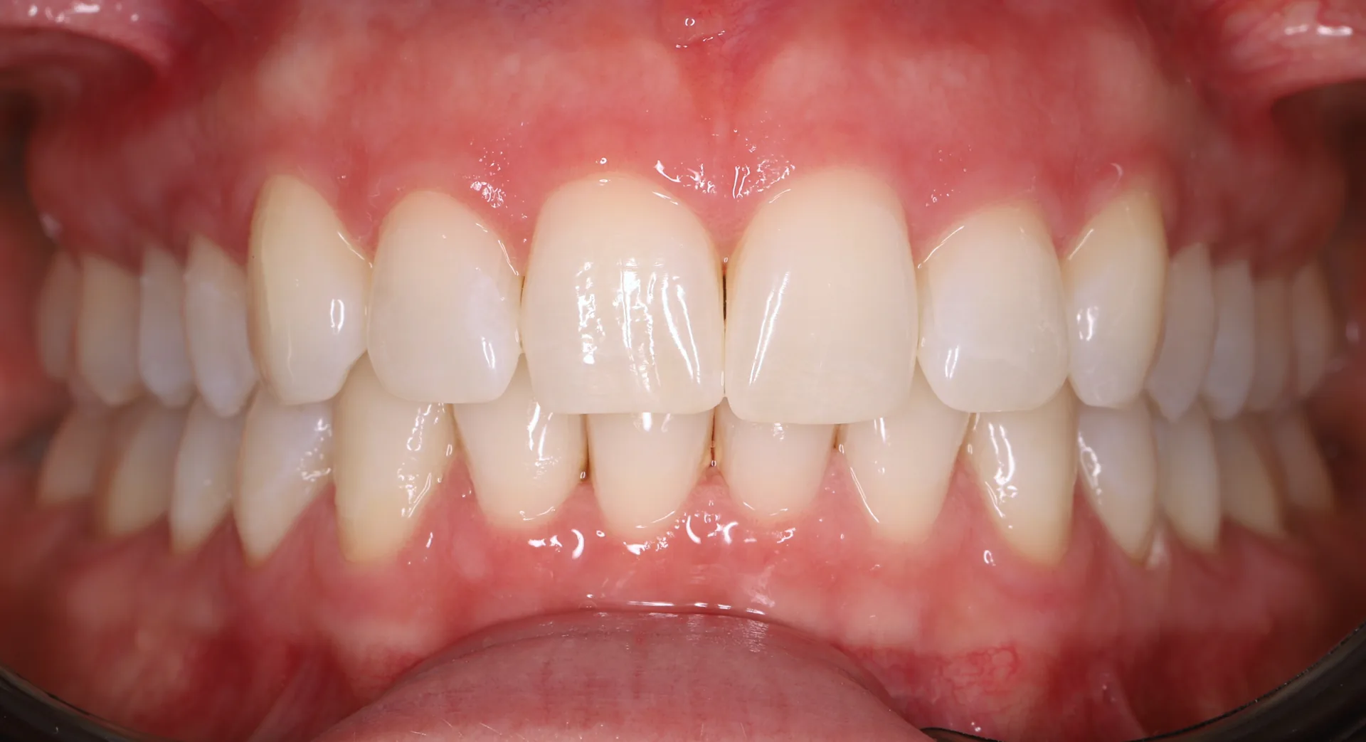 Zoom Whitening after