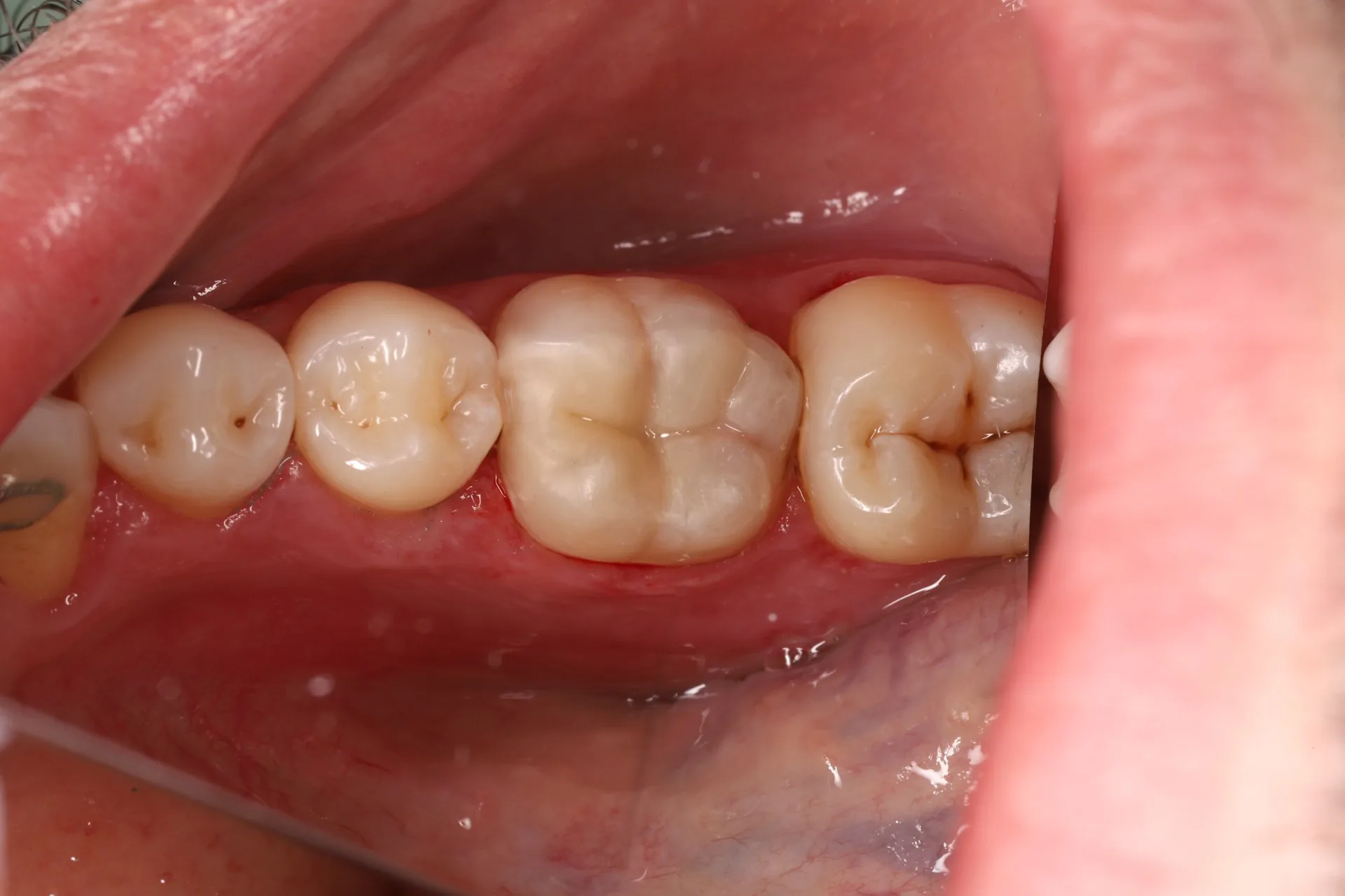 Amalgam Replacement — Tooth 46 after