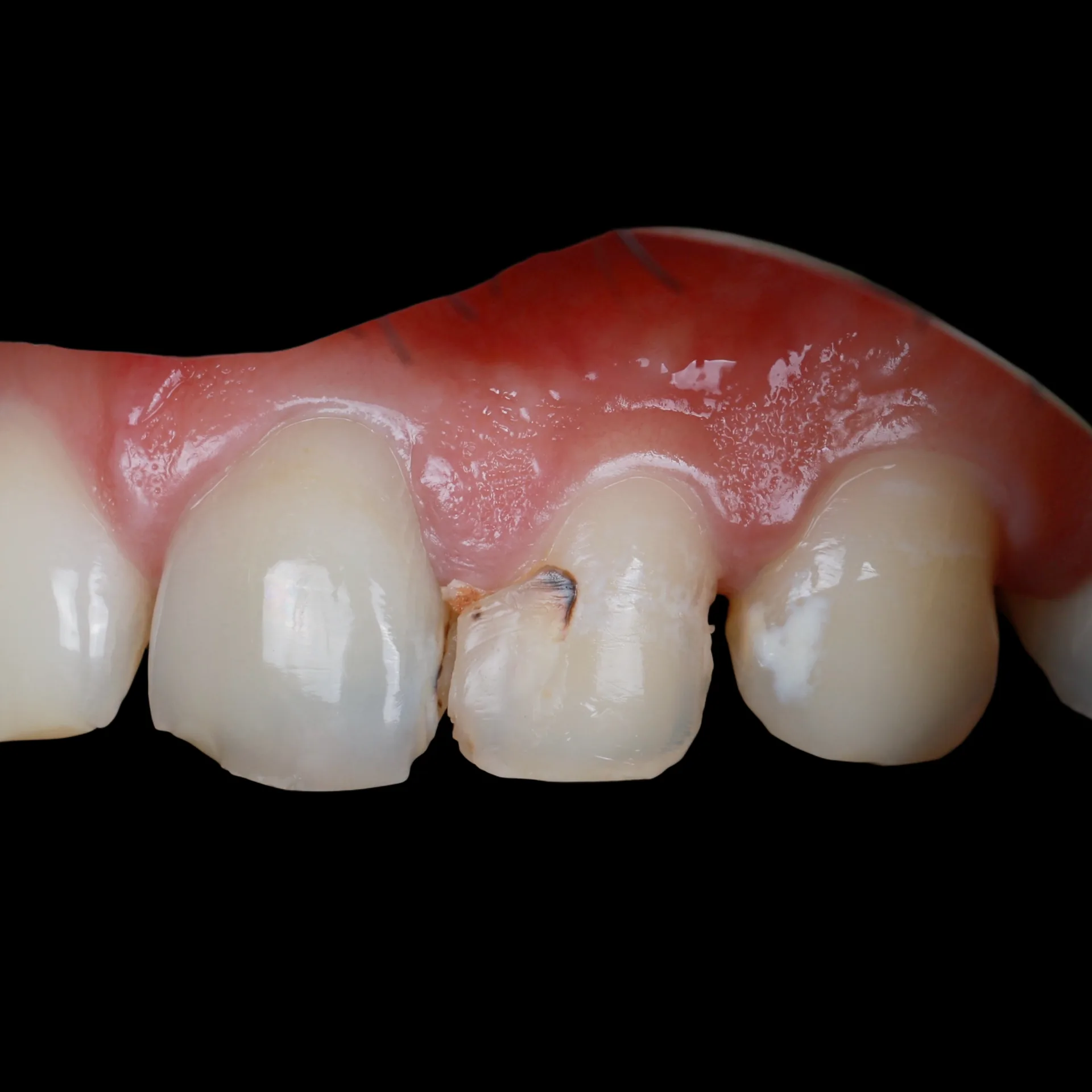 Composite Restoration — Tooth 10 after