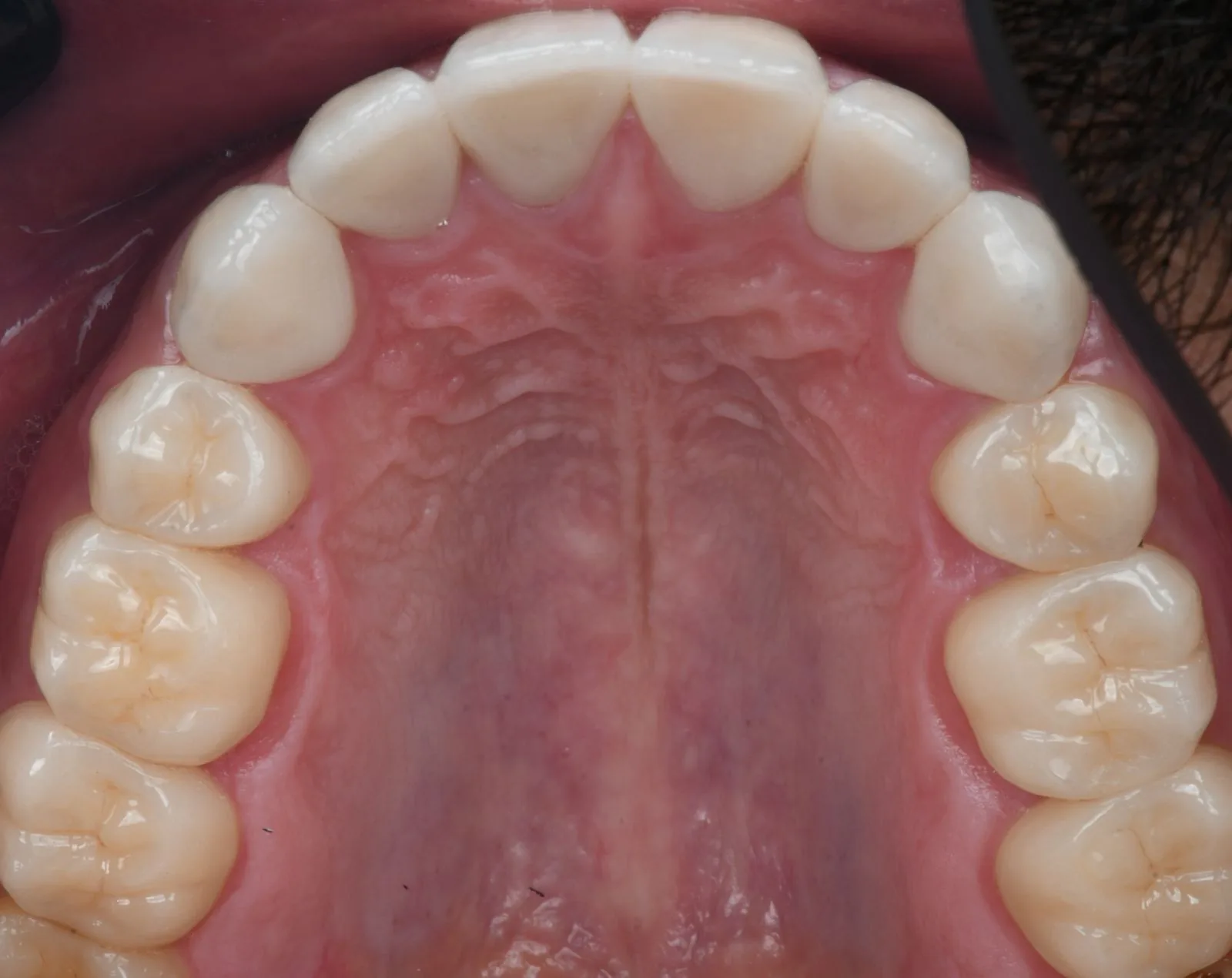 Lifelike Ceramic Crowns after