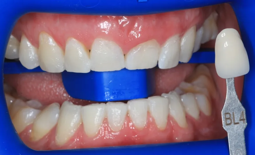 Teeth Whitening after