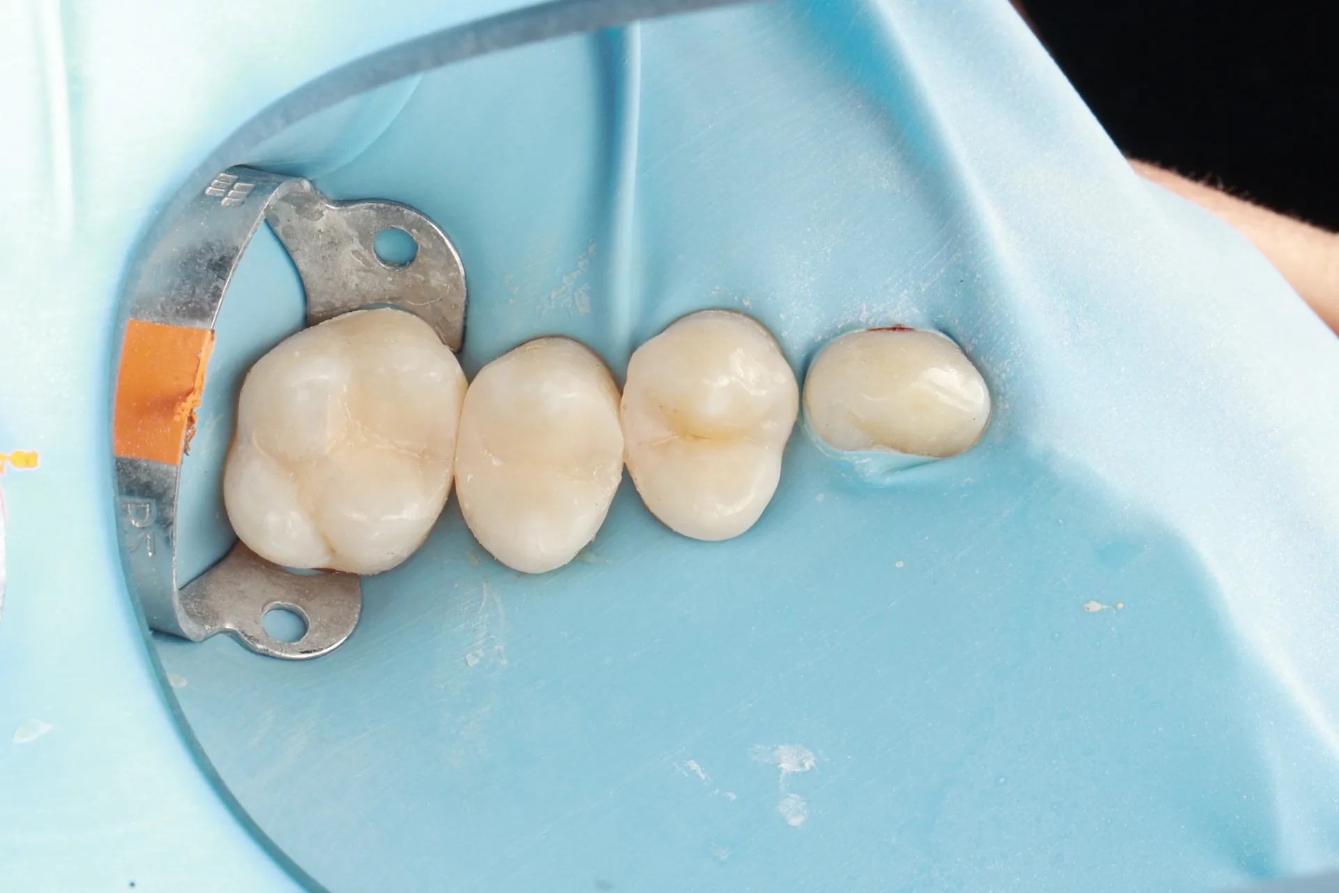 Composite Restoration — Teeth 13, 14 after