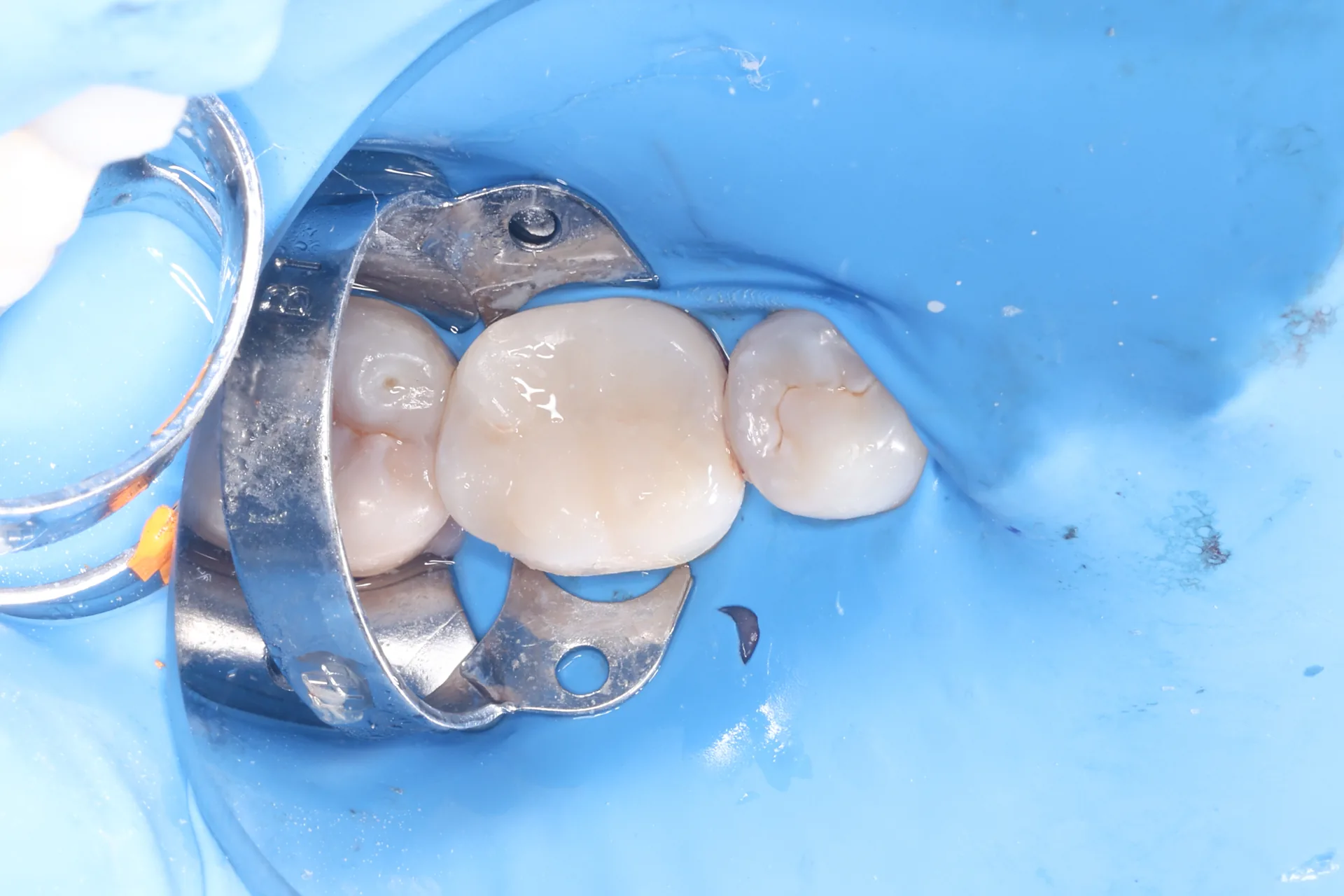 Restoration After Root Canal — Tooth 30 after
