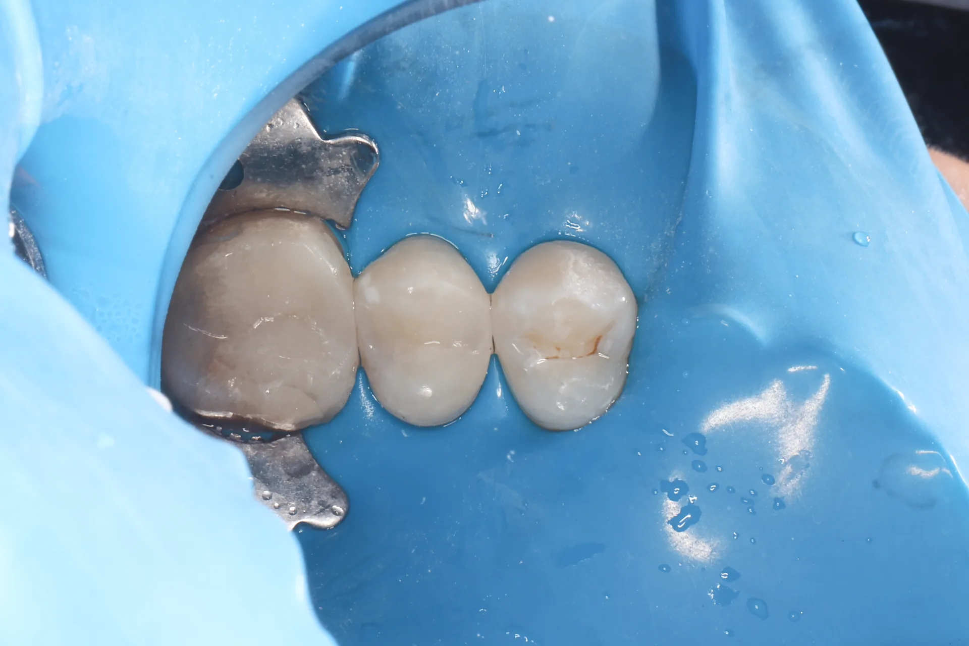 Composite Restoration — Tooth 13 after