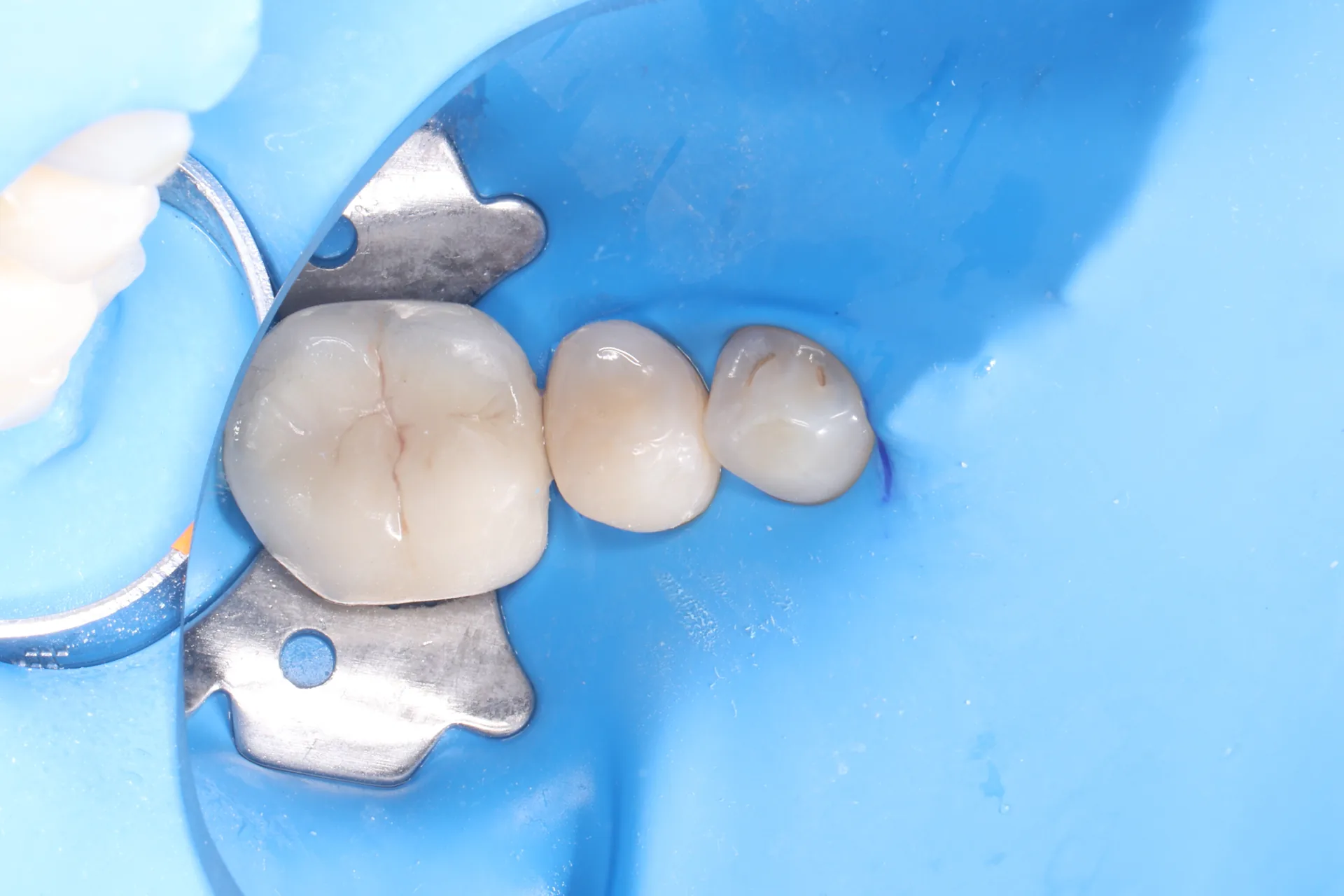 Composite Restoration — Tooth 29 after