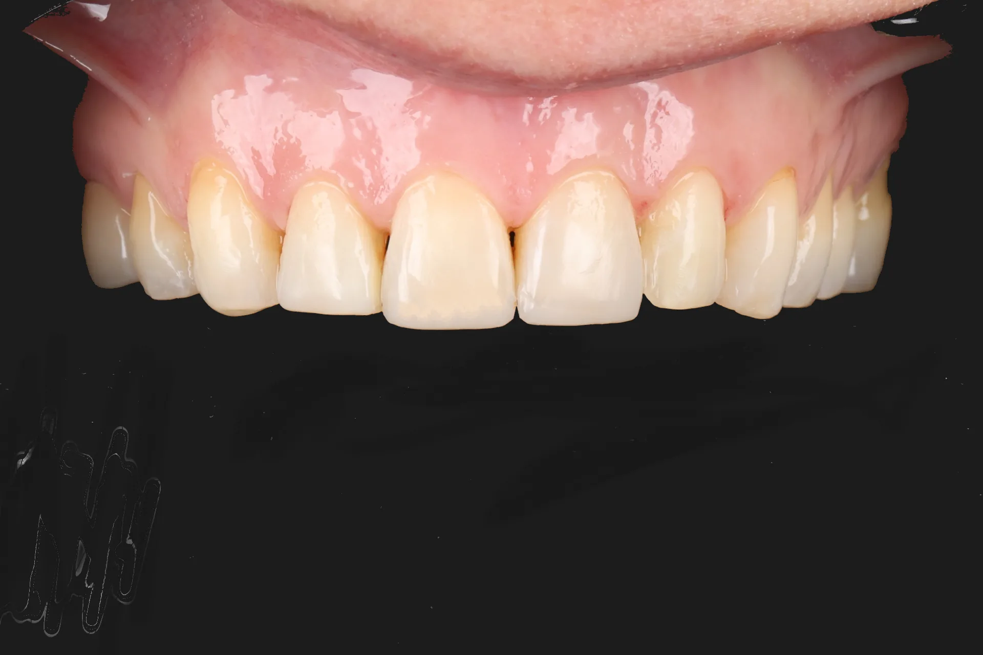 Composite Veneers — Front Teeth after