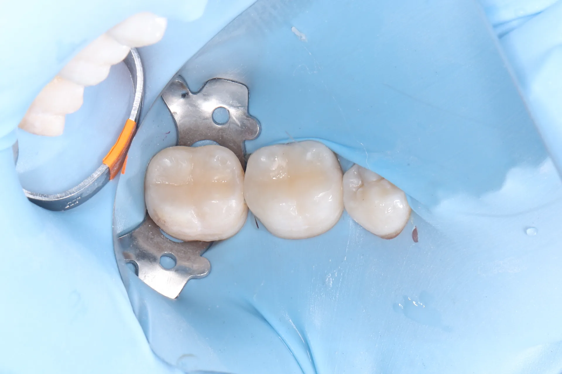 Composite Restoration — Teeth 30, 31 after