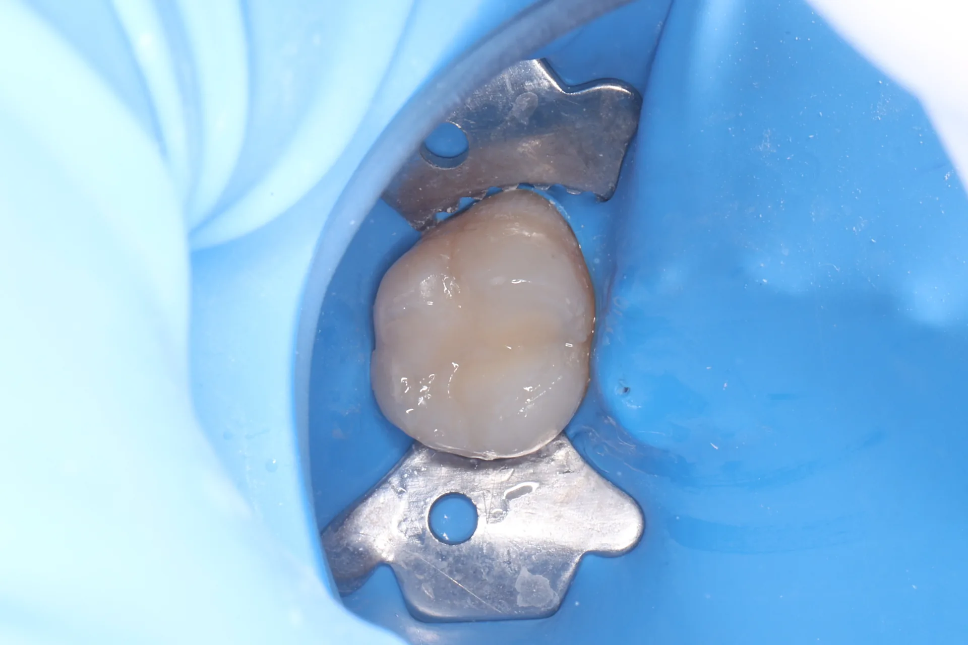 Composite Restoration — Tooth 14 after