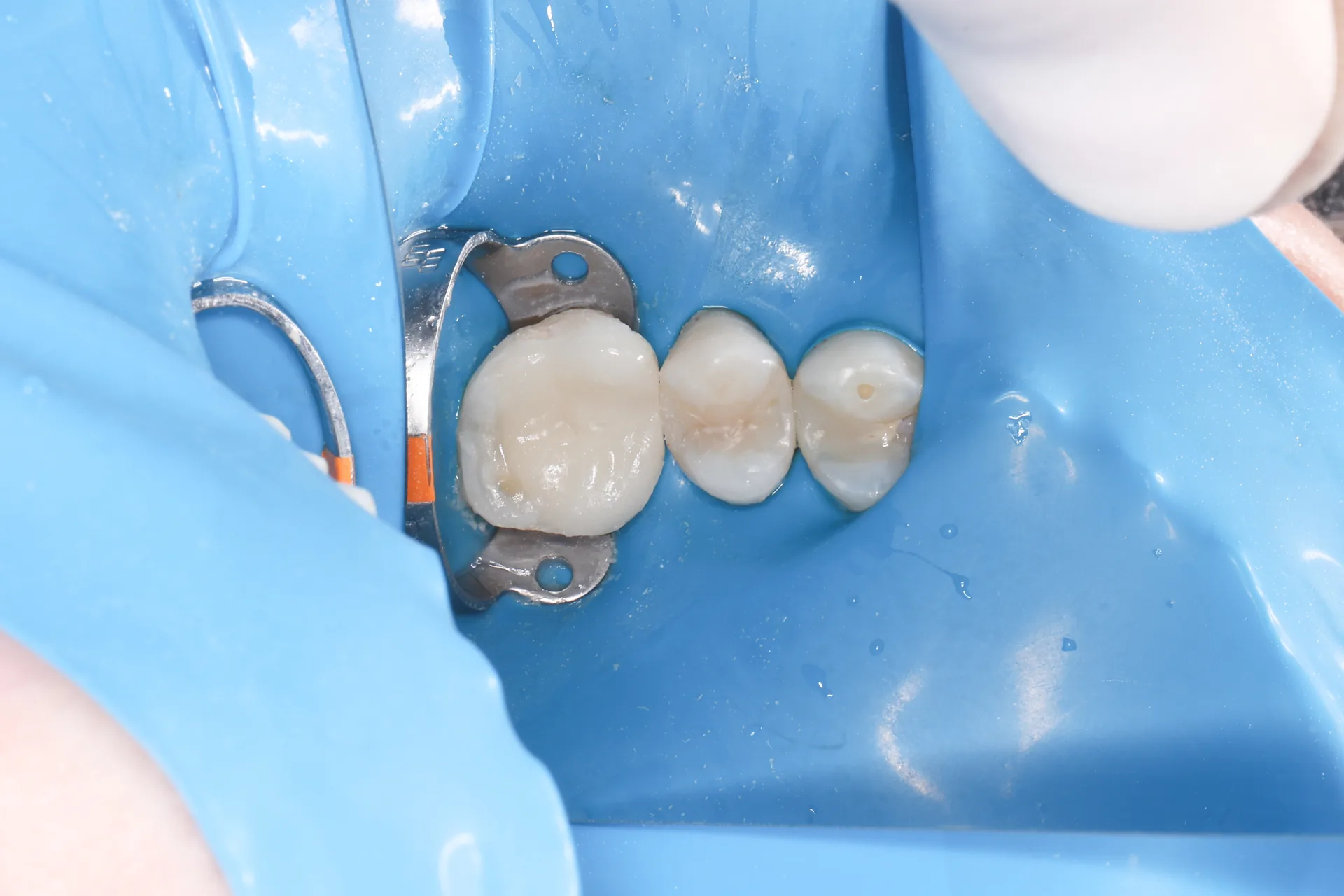 Restoration + Ceramic Onlay — Teeth 12, 13, 14 after