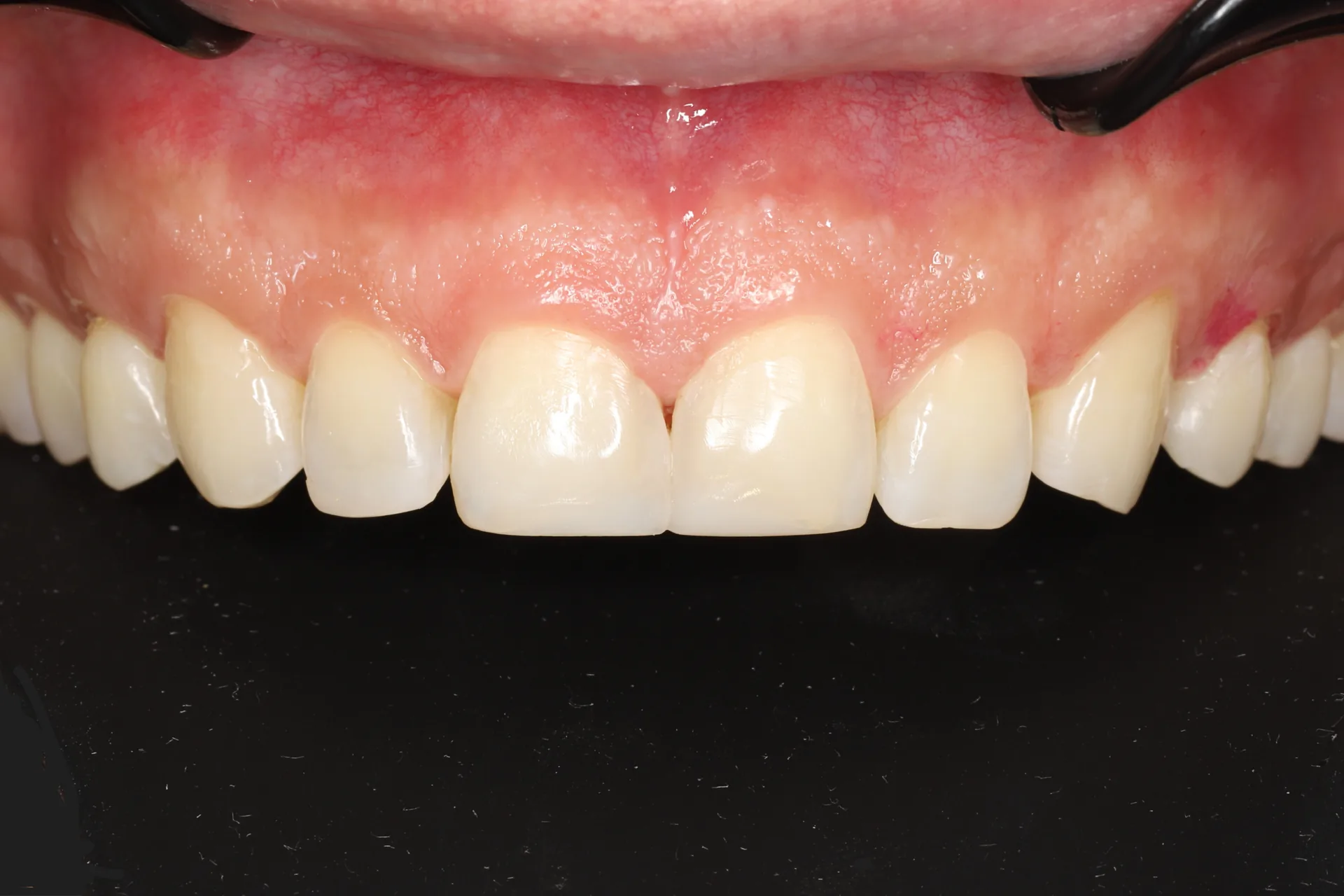 Anterior Composite — Teeth 8, 9 after