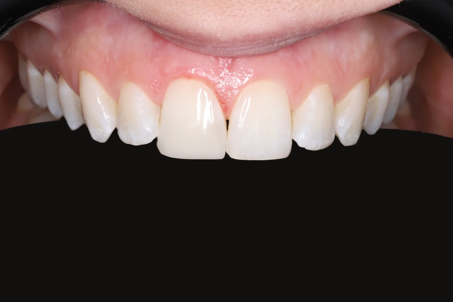 Incisal Edge Composite — Teeth 8, 9 after