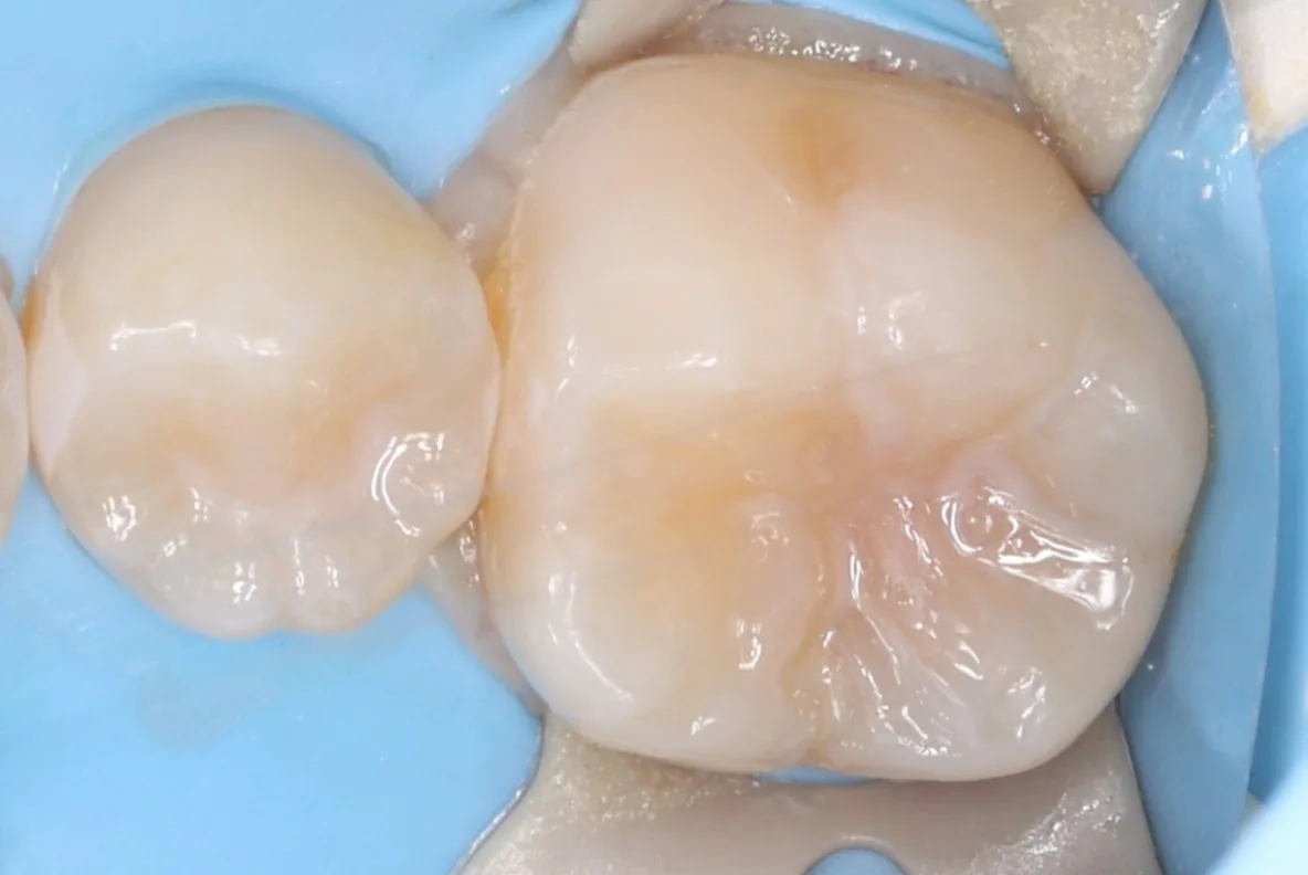 Pit & Fissure Sealants — Child after