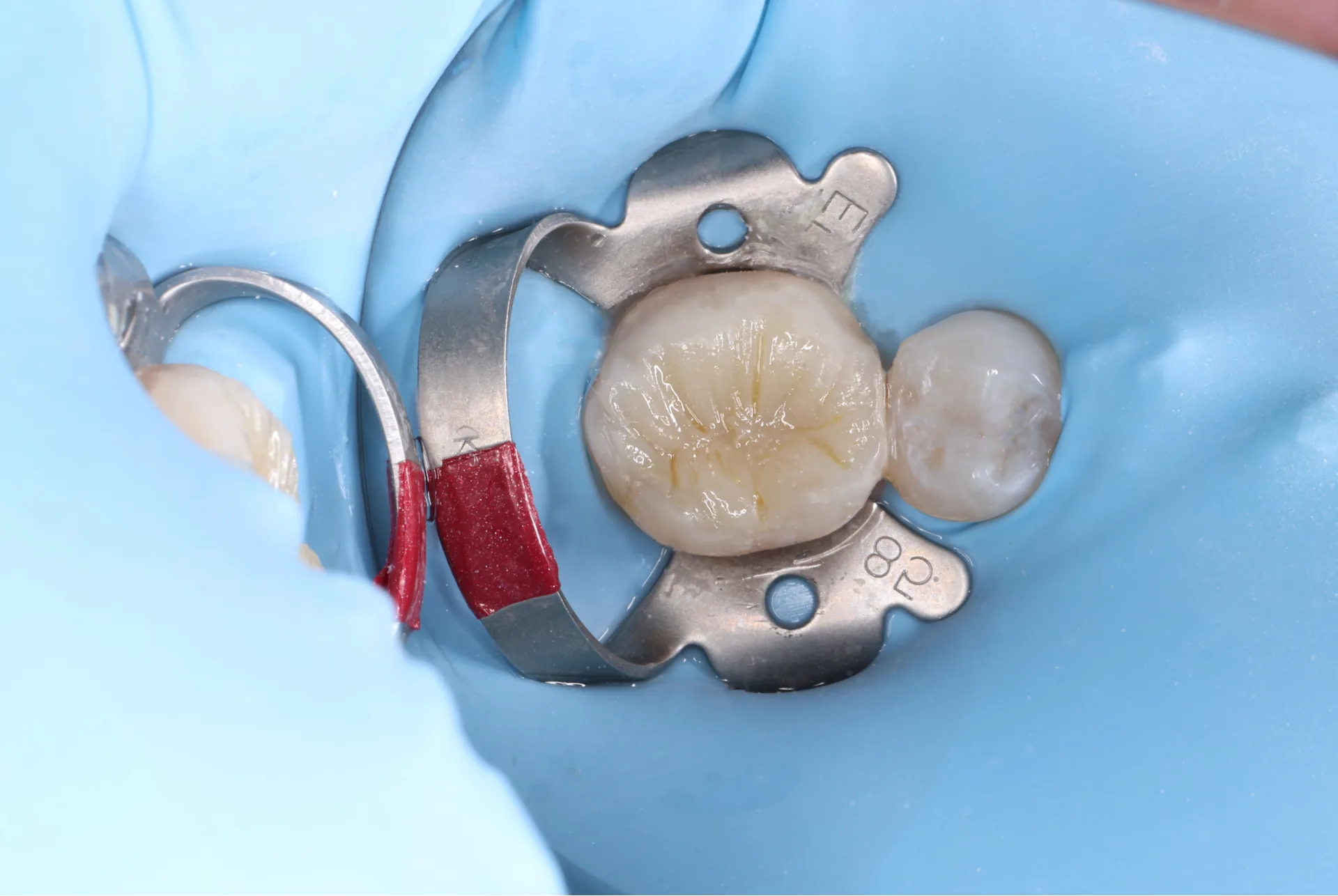 Composite Restoration — Tooth 19 after
