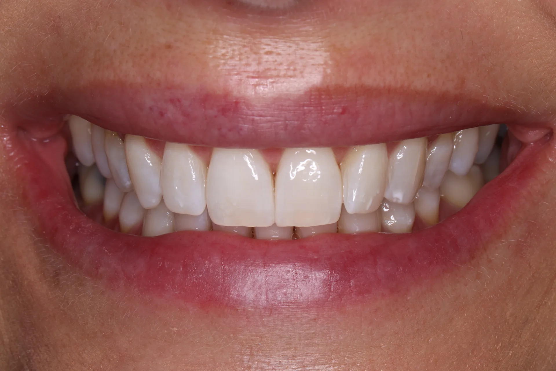 Teeth Whitening after