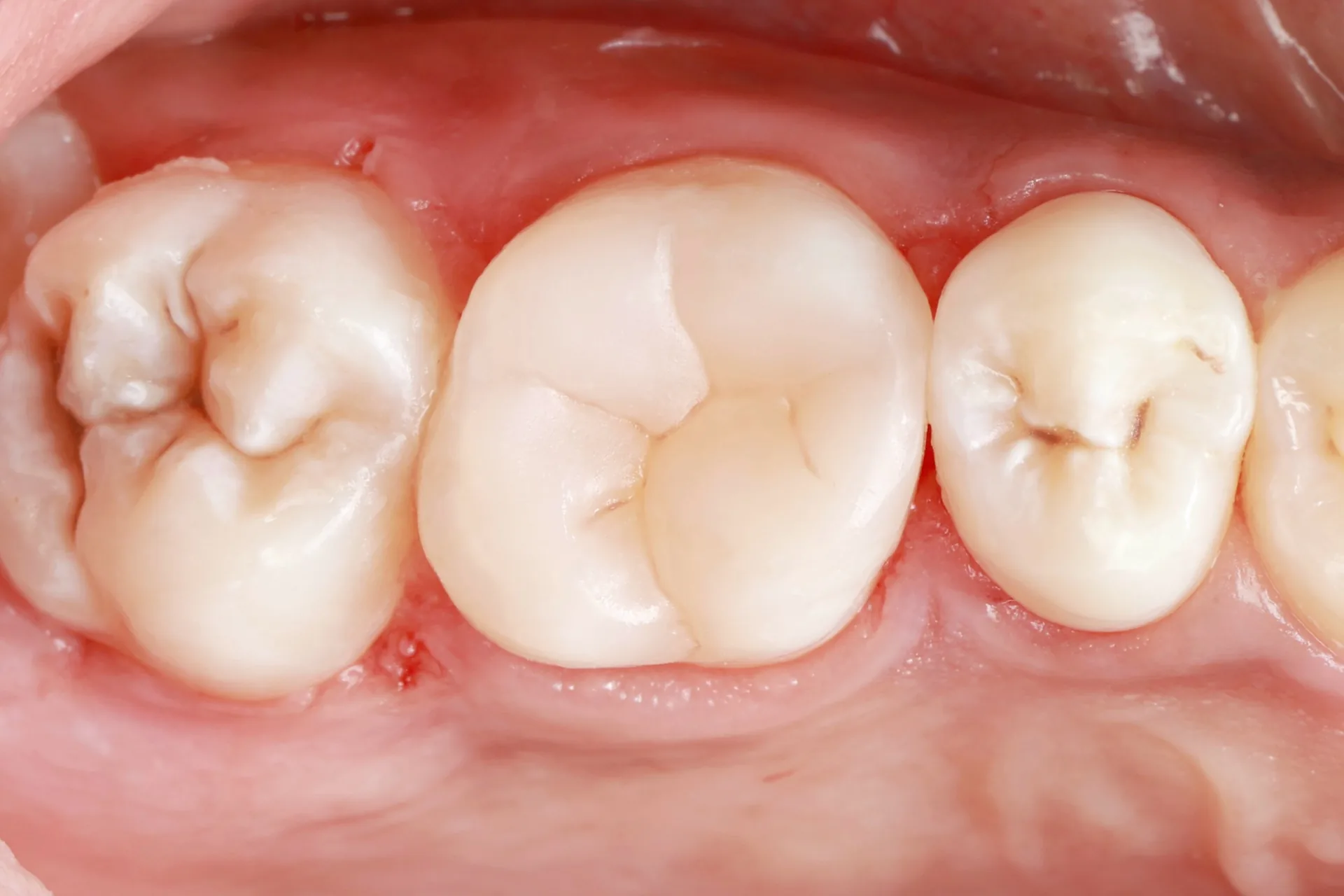 Composite Filling — Tooth 14 after