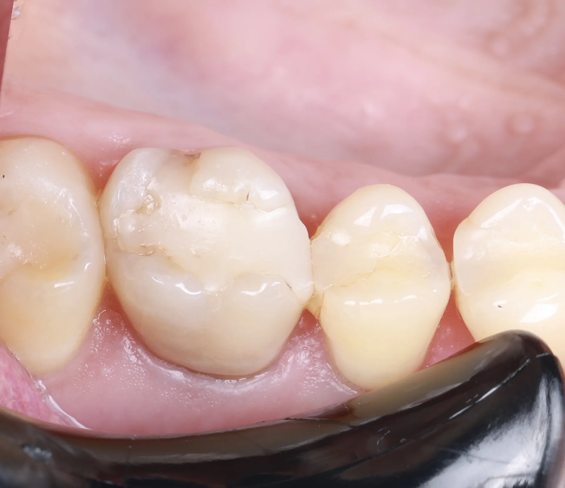 Ceramic Overlay — Tooth 3 before
