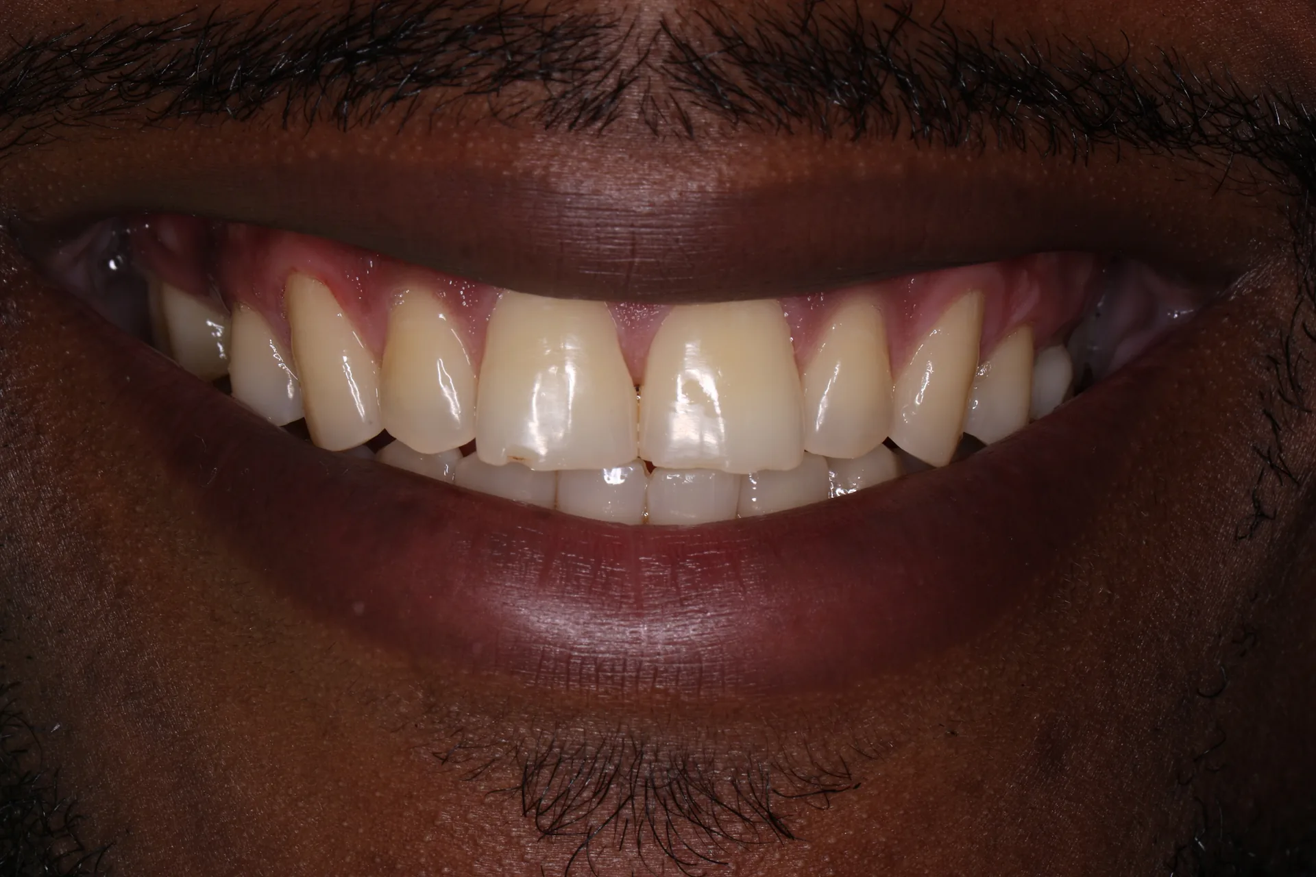 Zoom Whitening before