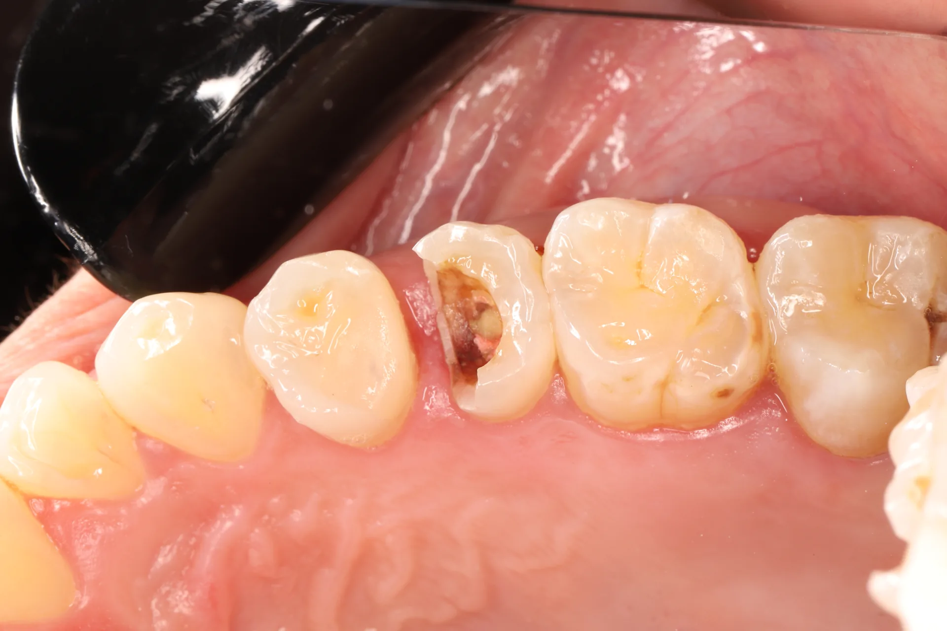 Ceramic Crown — Tooth 25 before