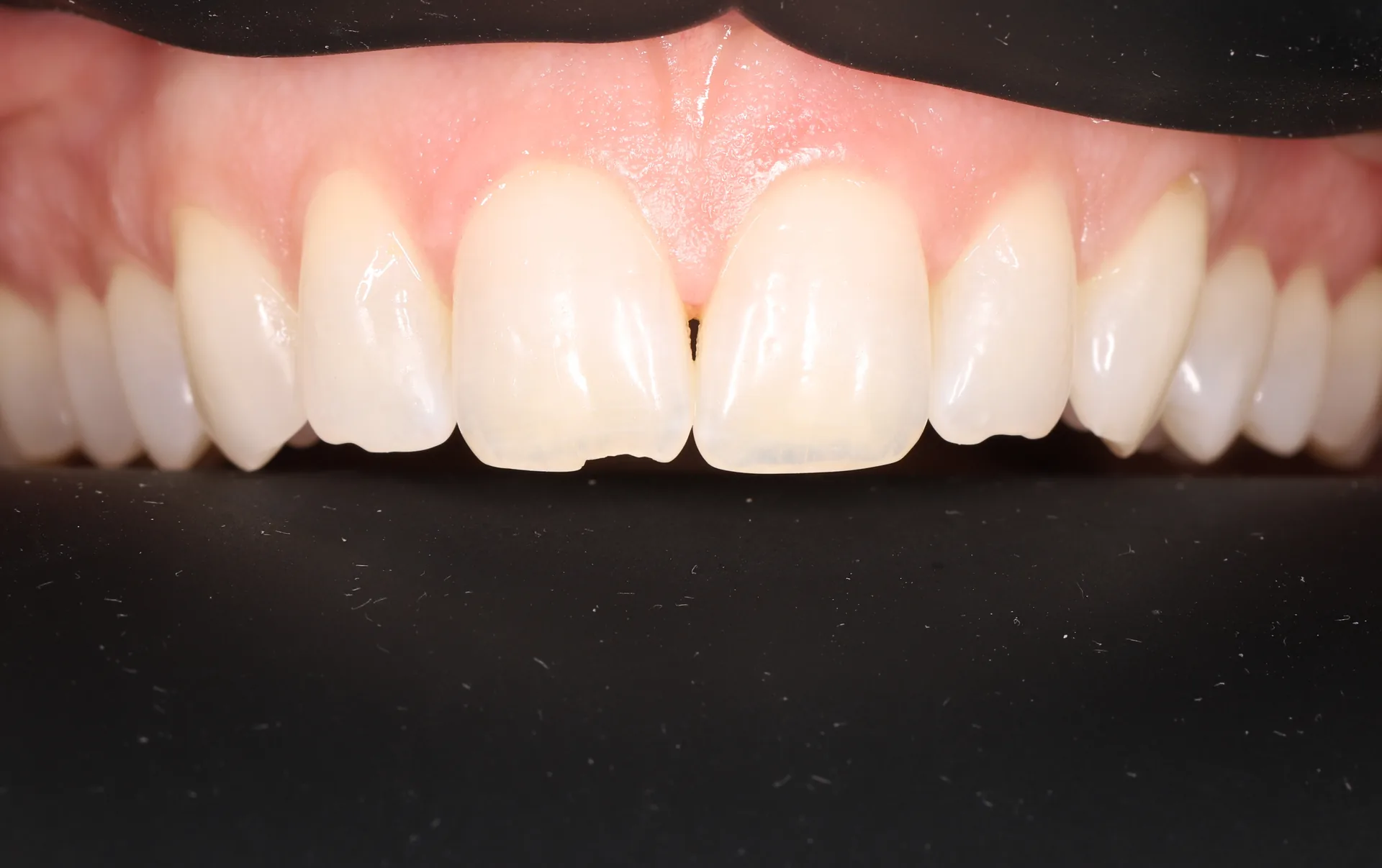 Chipped Teeth Restoration before