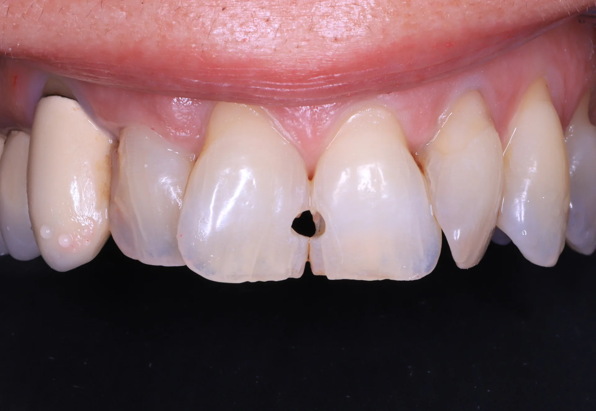 Seamless Caries Restoration — Front Teeth before