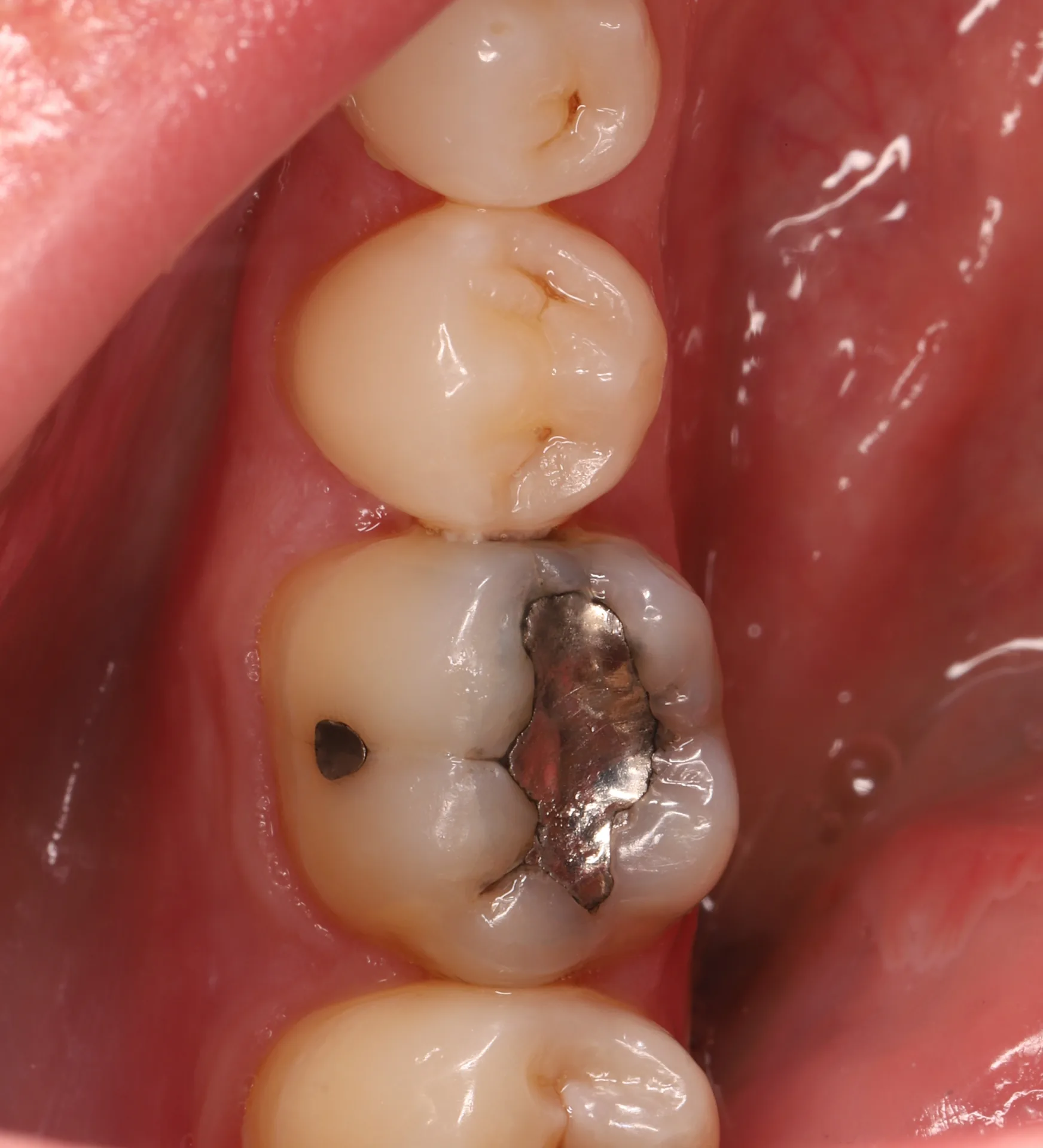 Amalgam Replacement — Tooth 36 before