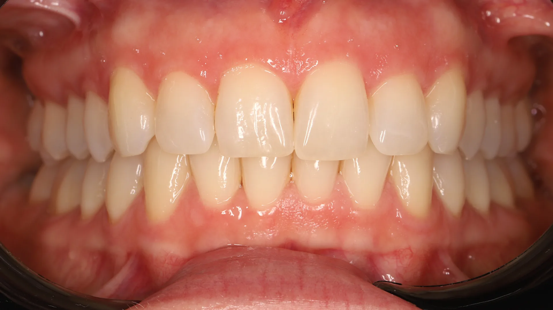 Zoom Whitening before