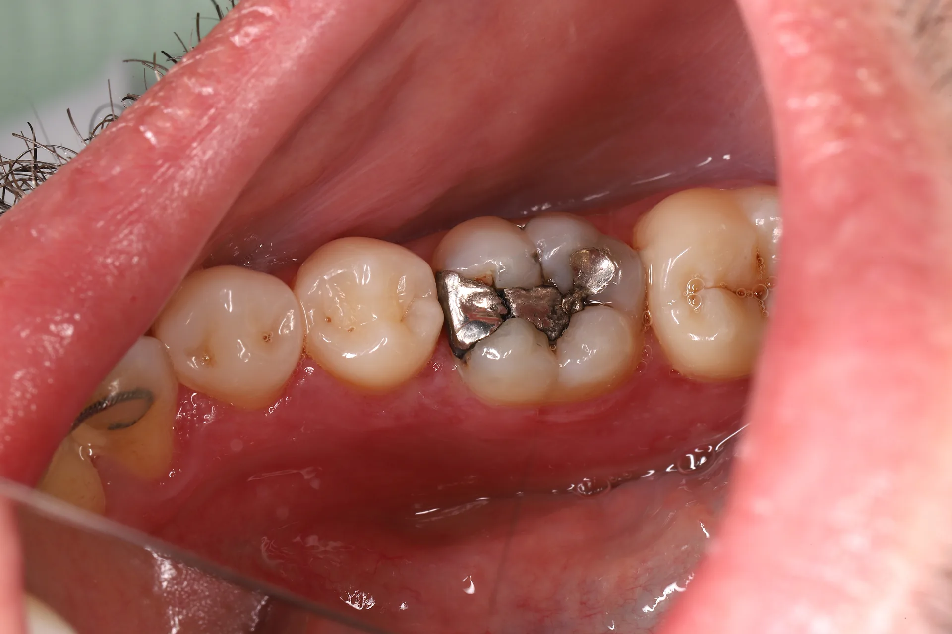 Amalgam Replacement — Tooth 46 before