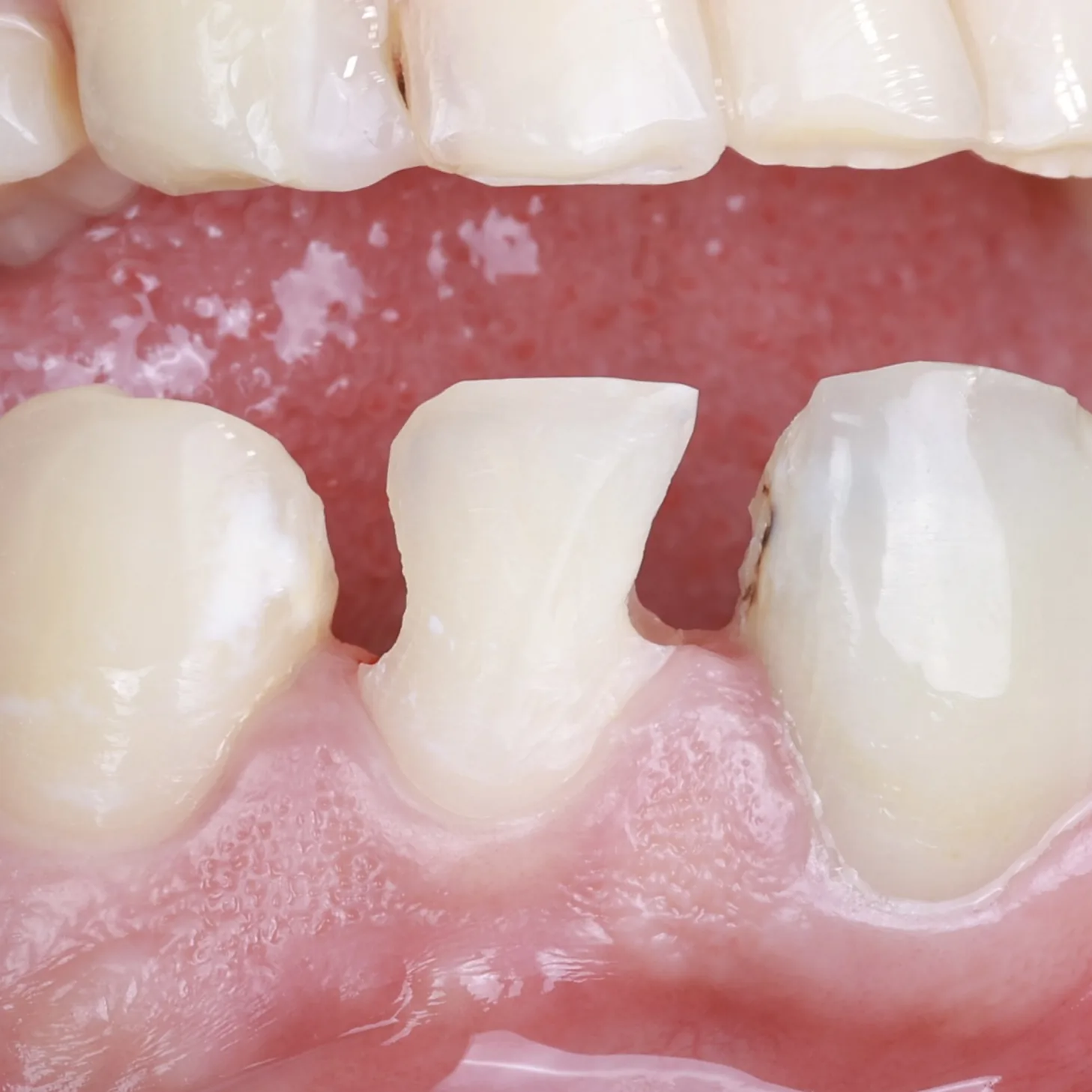 Composite Restoration — Tooth 10 before