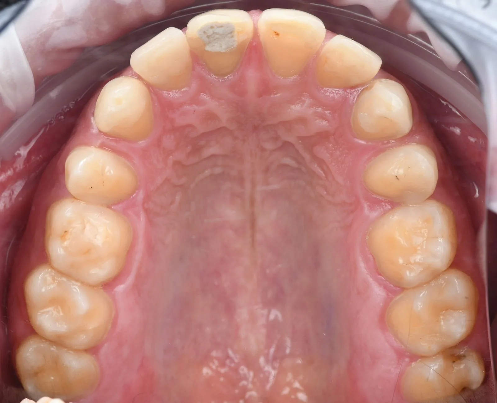 Lifelike Ceramic Crowns before