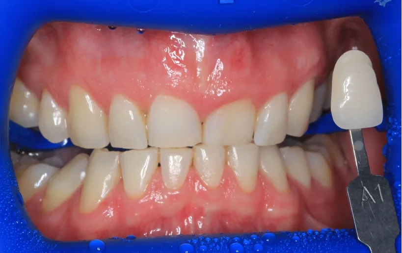 Teeth Whitening before