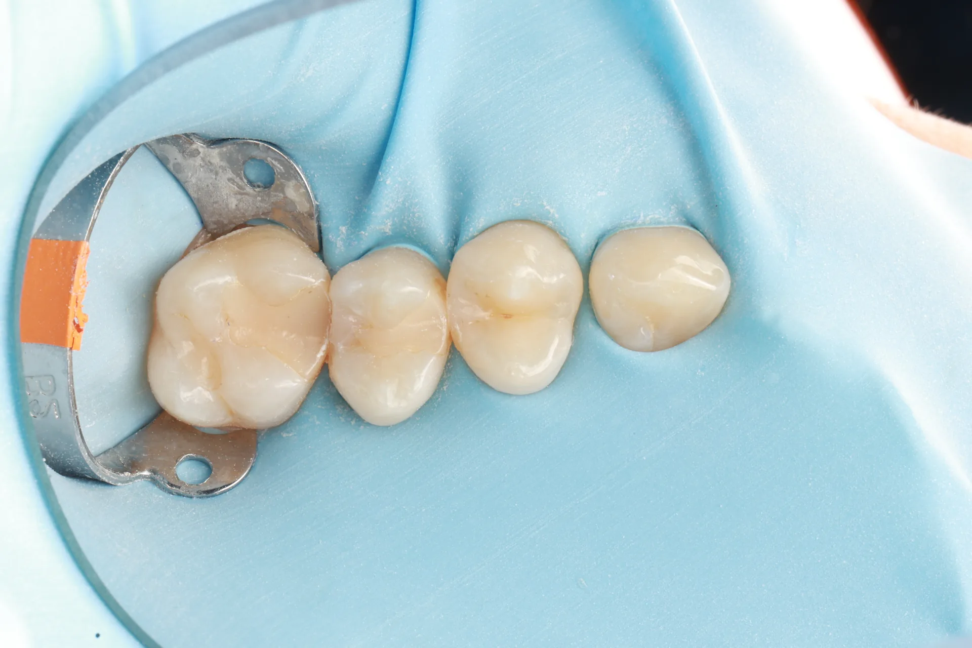 Composite Restoration — Teeth 13, 14 before