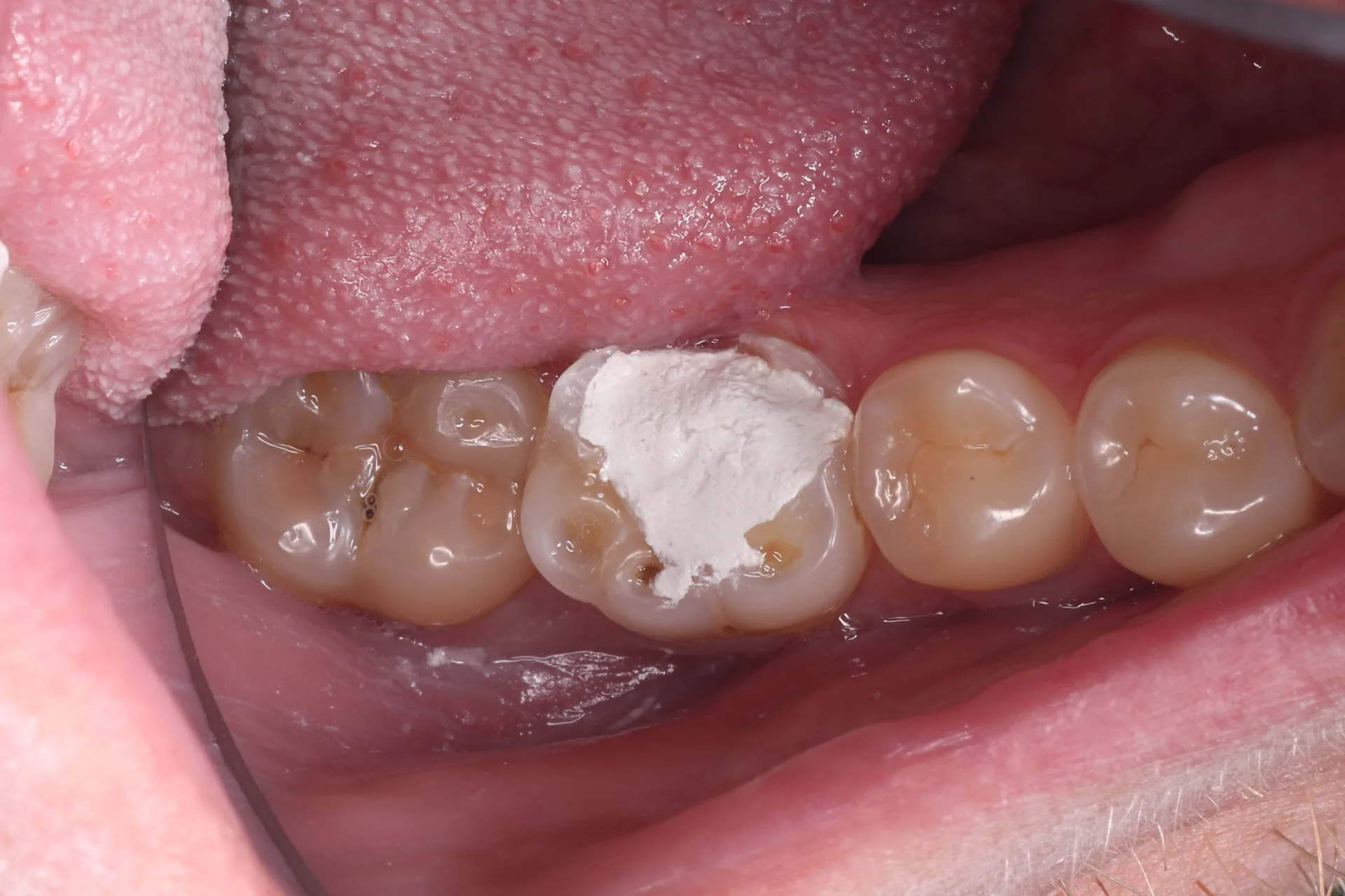 Restoration After Root Canal — Tooth 30 before