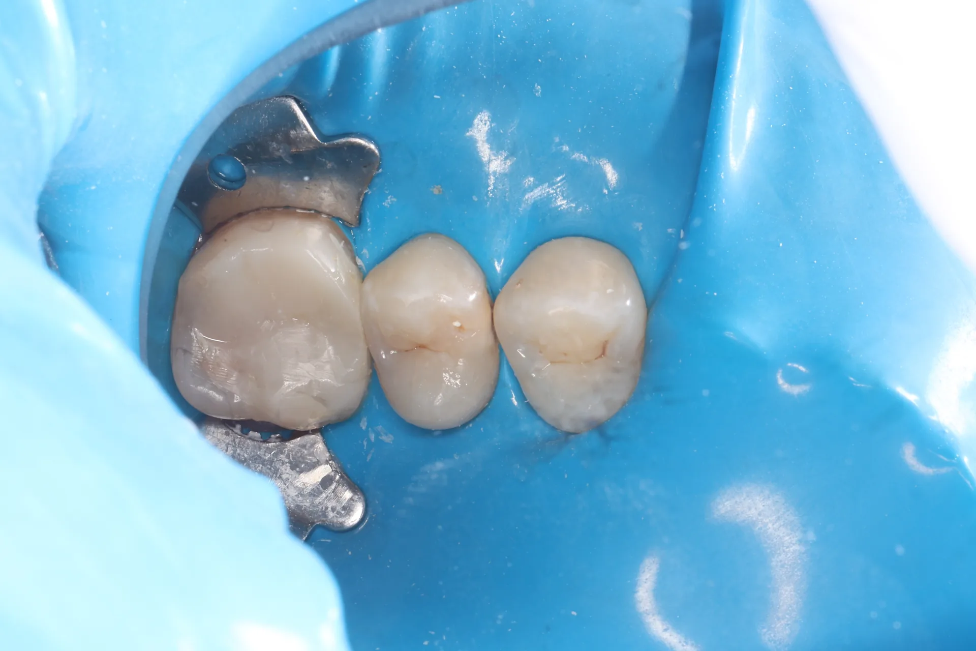 Composite Restoration — Tooth 13 before