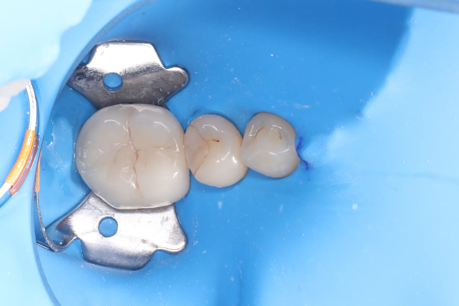 Composite Restoration — Tooth 29 before