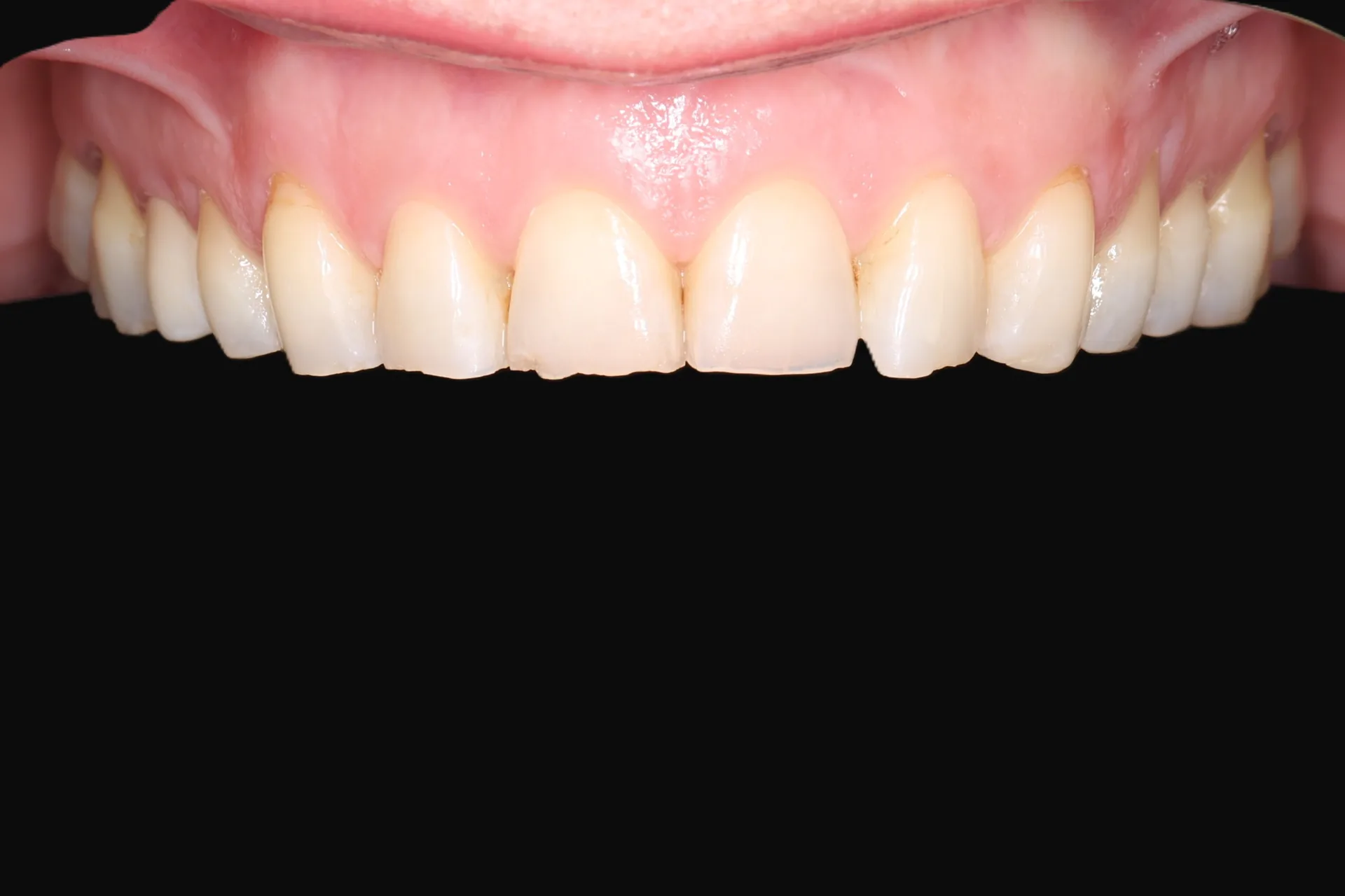 Composite Veneers — Front Teeth before