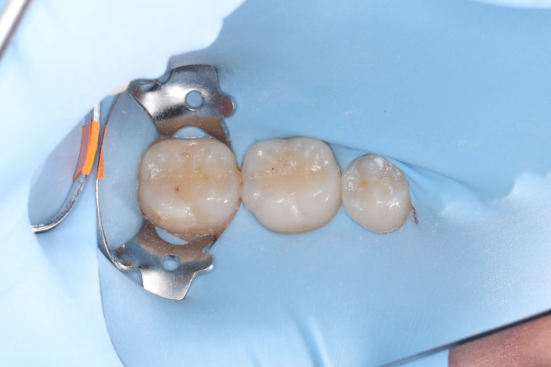 Composite Restoration — Teeth 30, 31 before