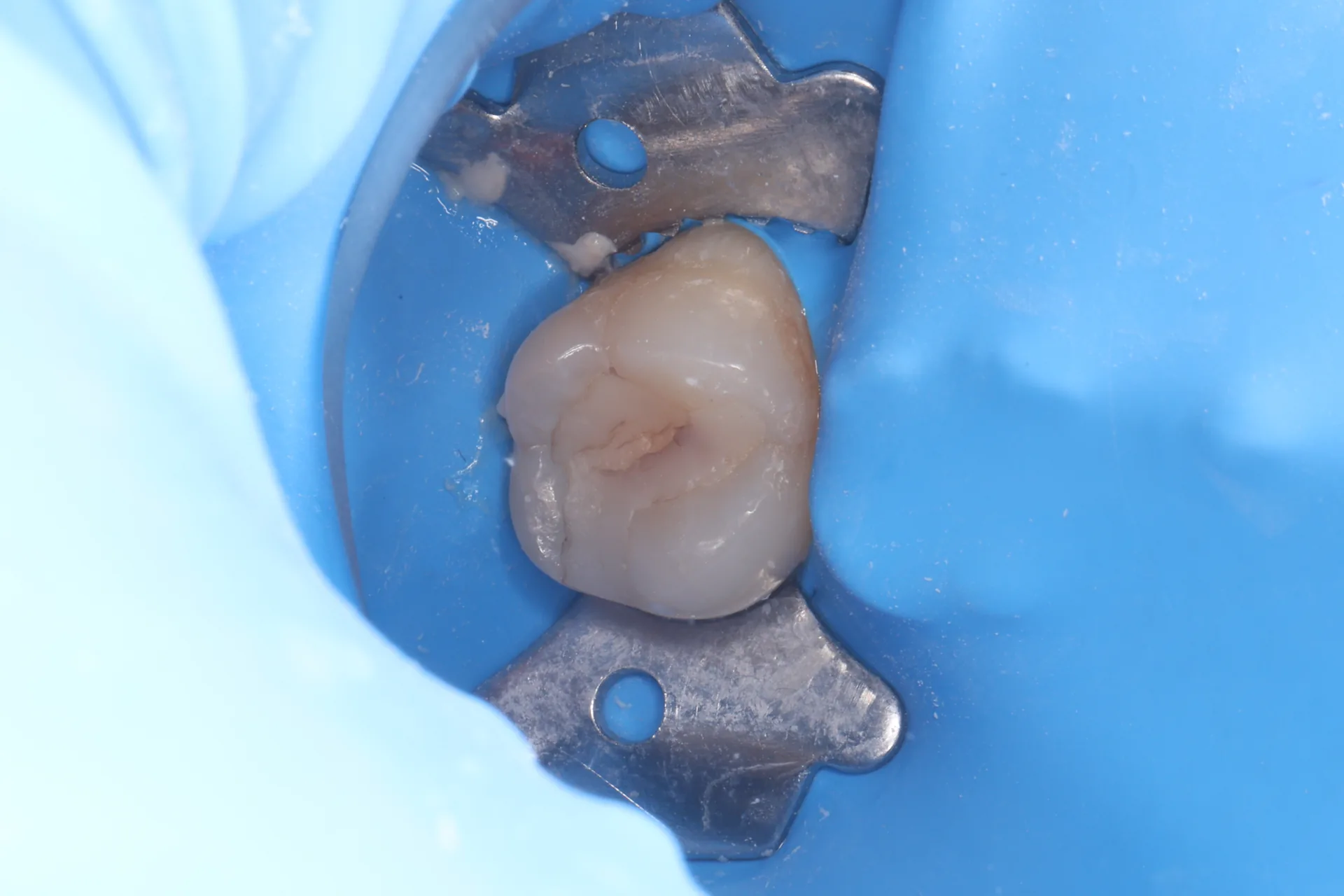 Composite Restoration — Tooth 14 before
