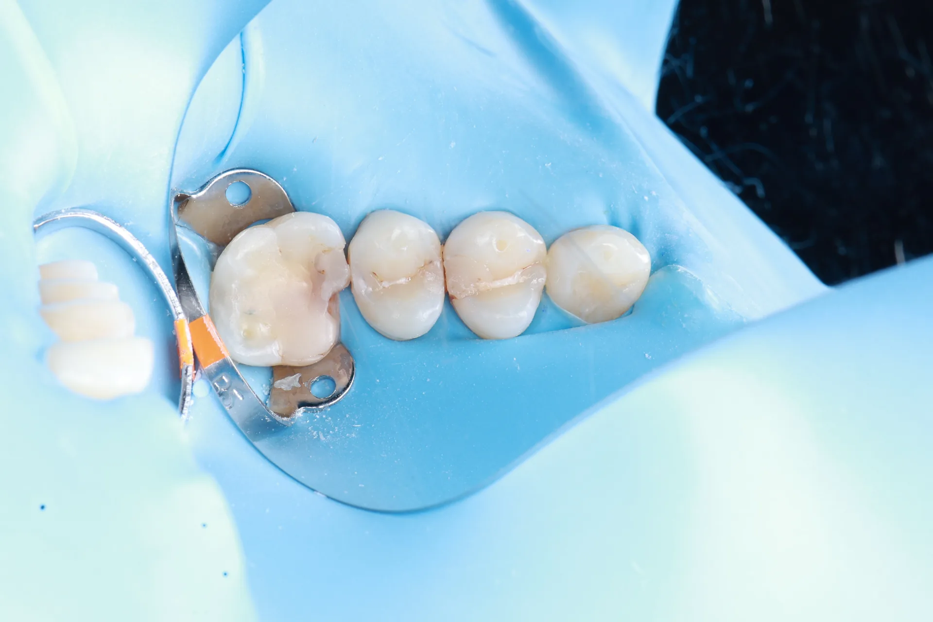 Restoration + Ceramic Onlay — Teeth 12, 13, 14 before