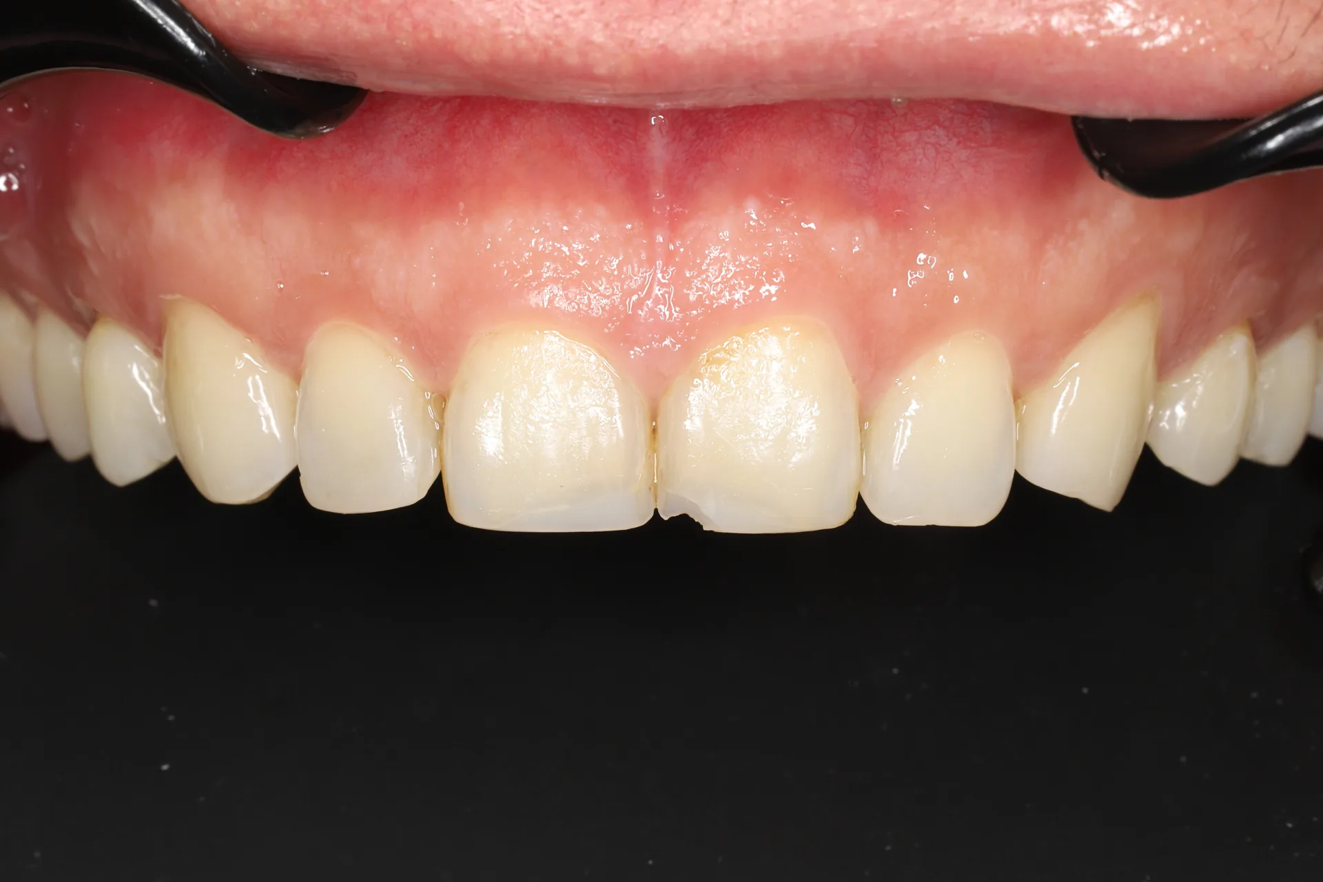 Anterior Composite — Teeth 8, 9 before