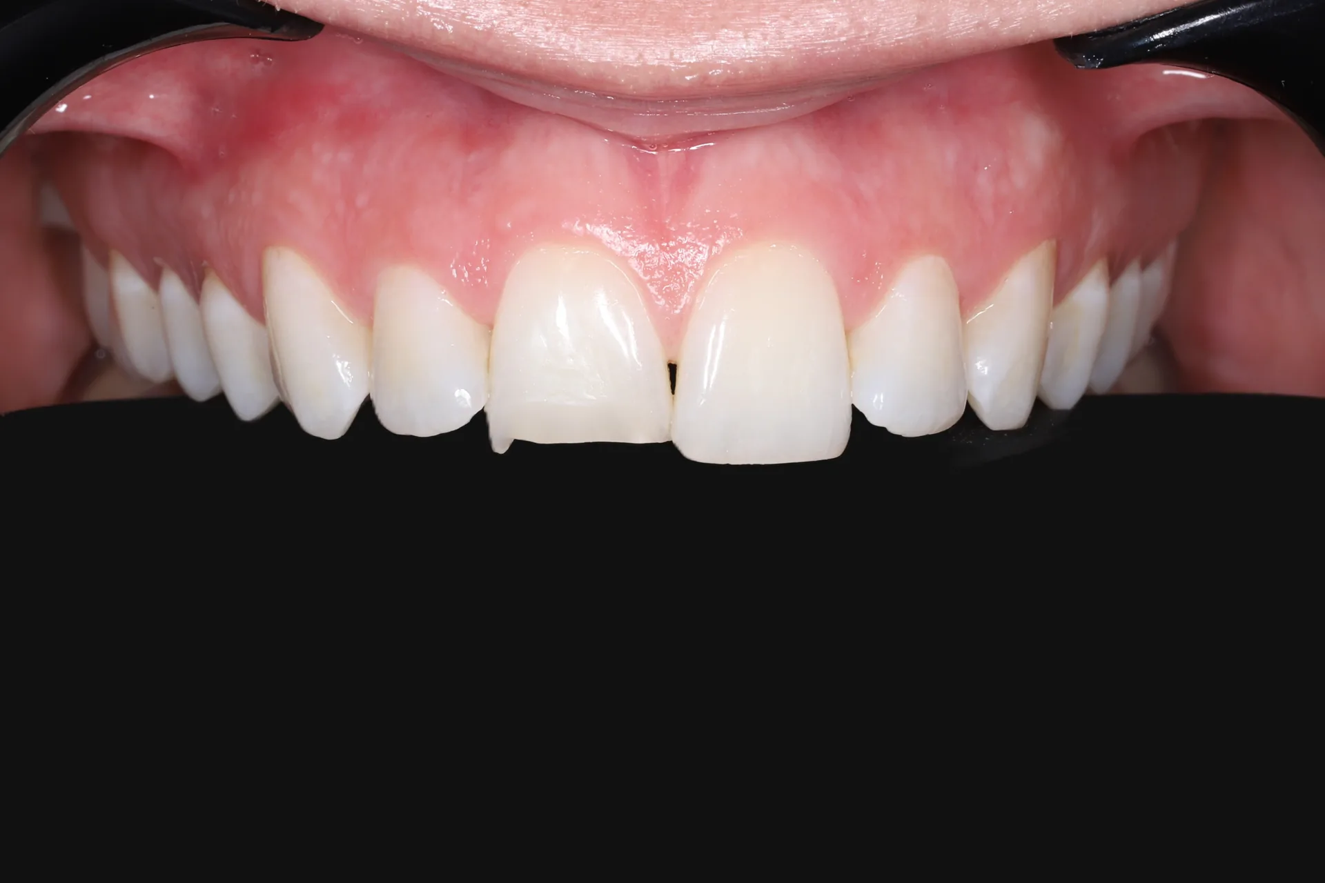 Incisal Edge Composite — Teeth 8, 9 before