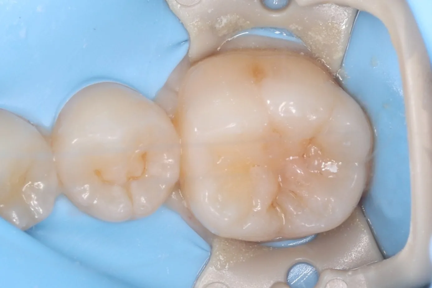 Pit & Fissure Sealants — Child before
