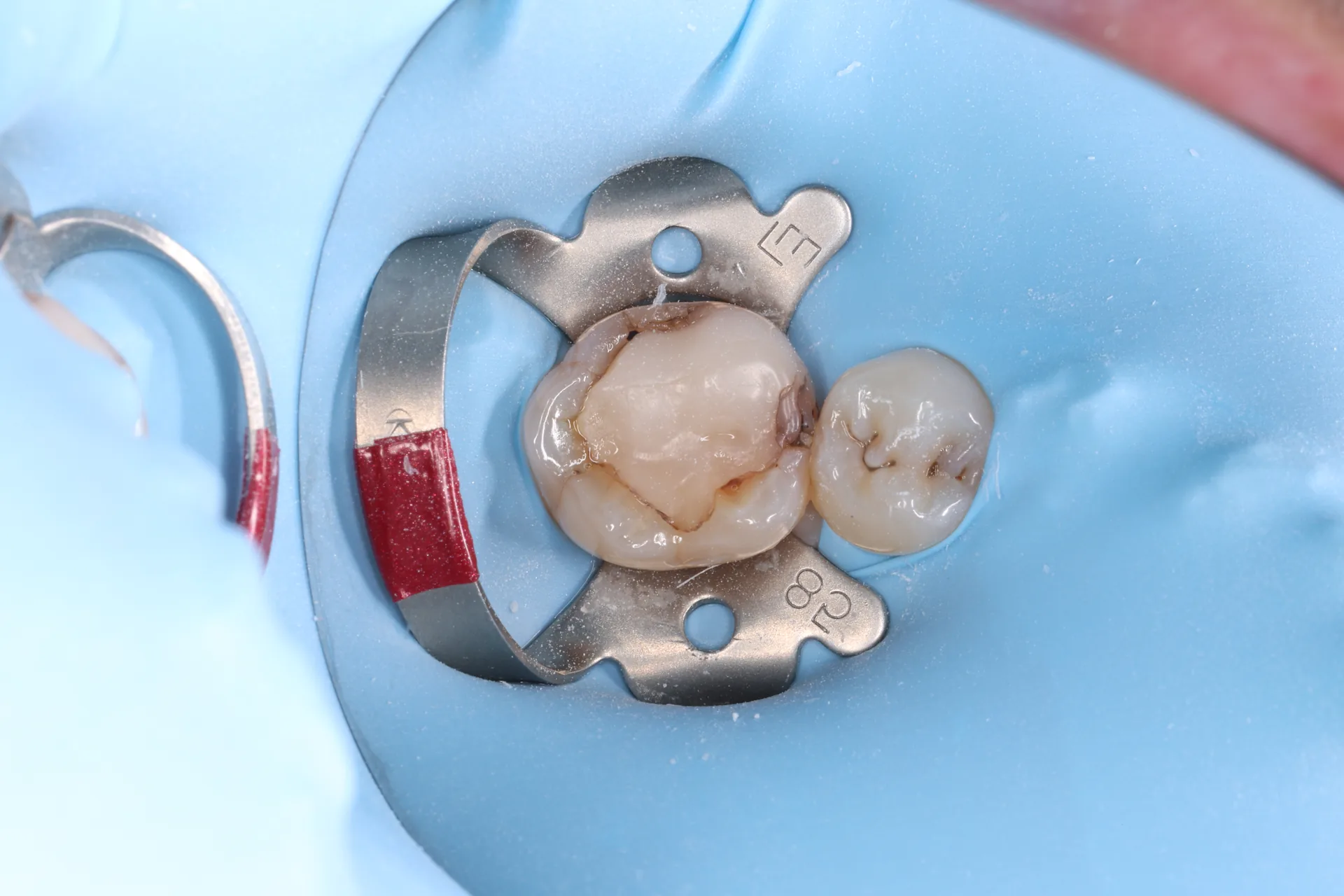 Composite Restoration — Tooth 19 before