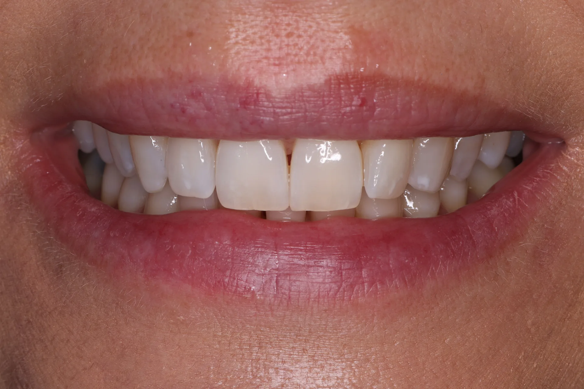Teeth Whitening before